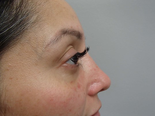 Rhinoplasty (Nose Job) Images After