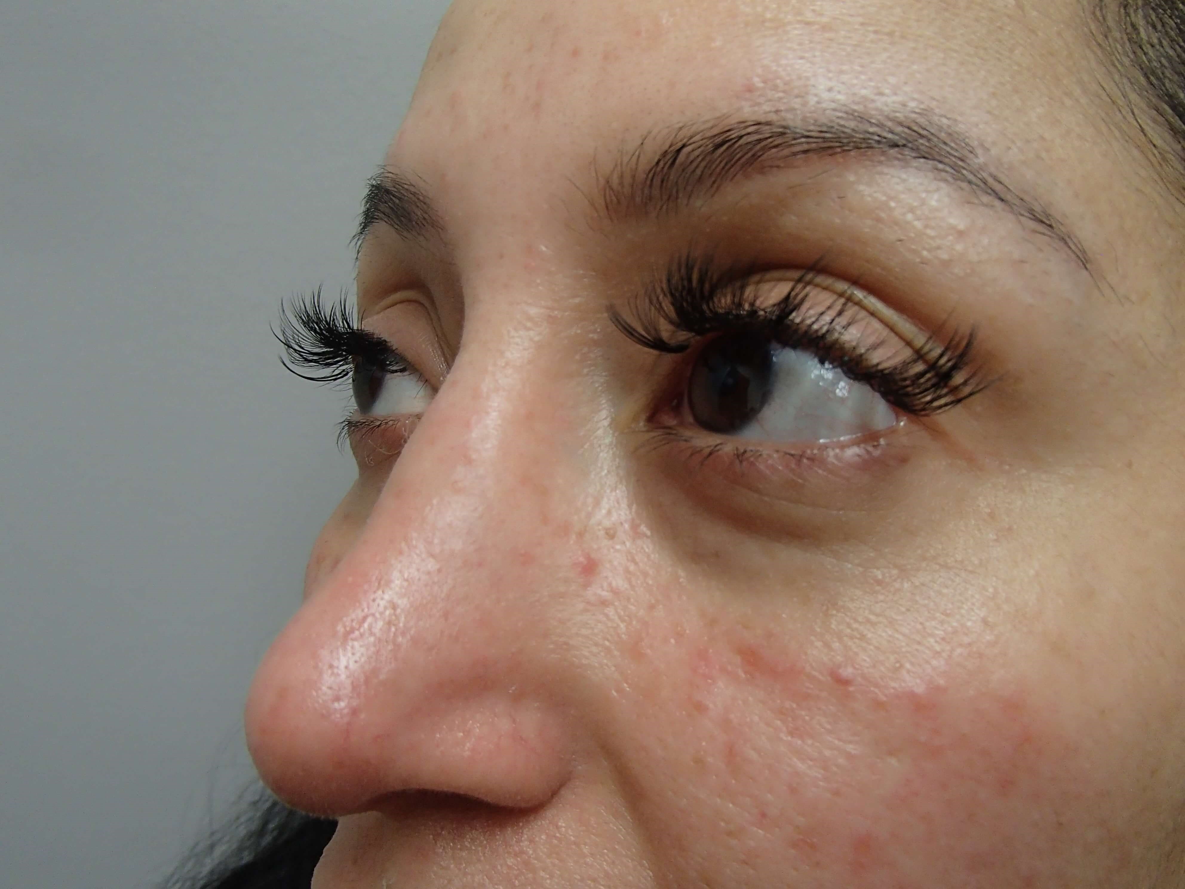 Rhinoplasty (Nose Job) After