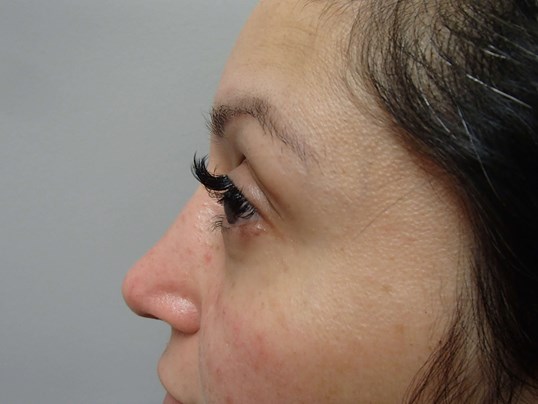 Rhinoplasty (Nose Job) After