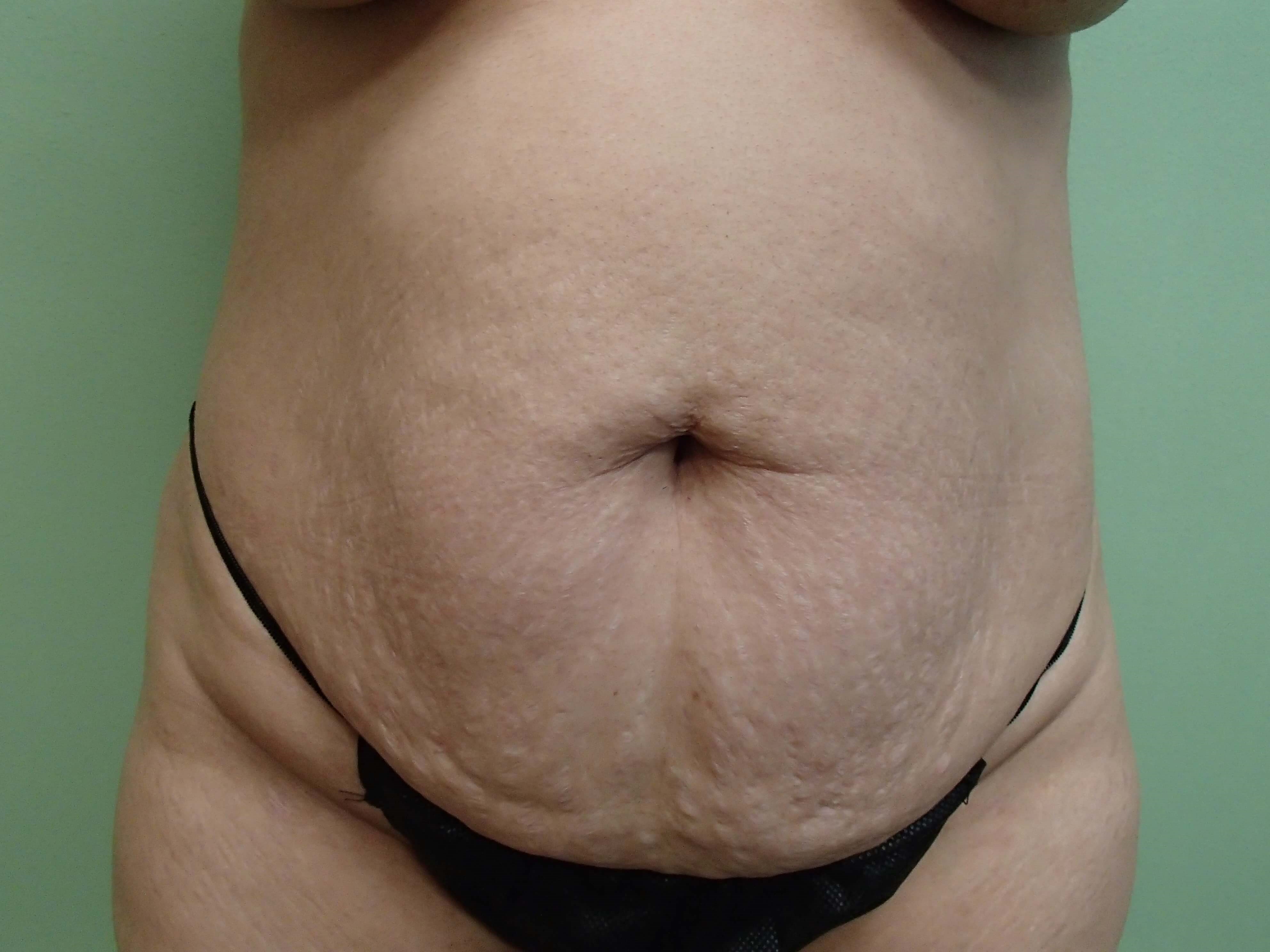 Timeless Tuck - Abdominoplasty Before