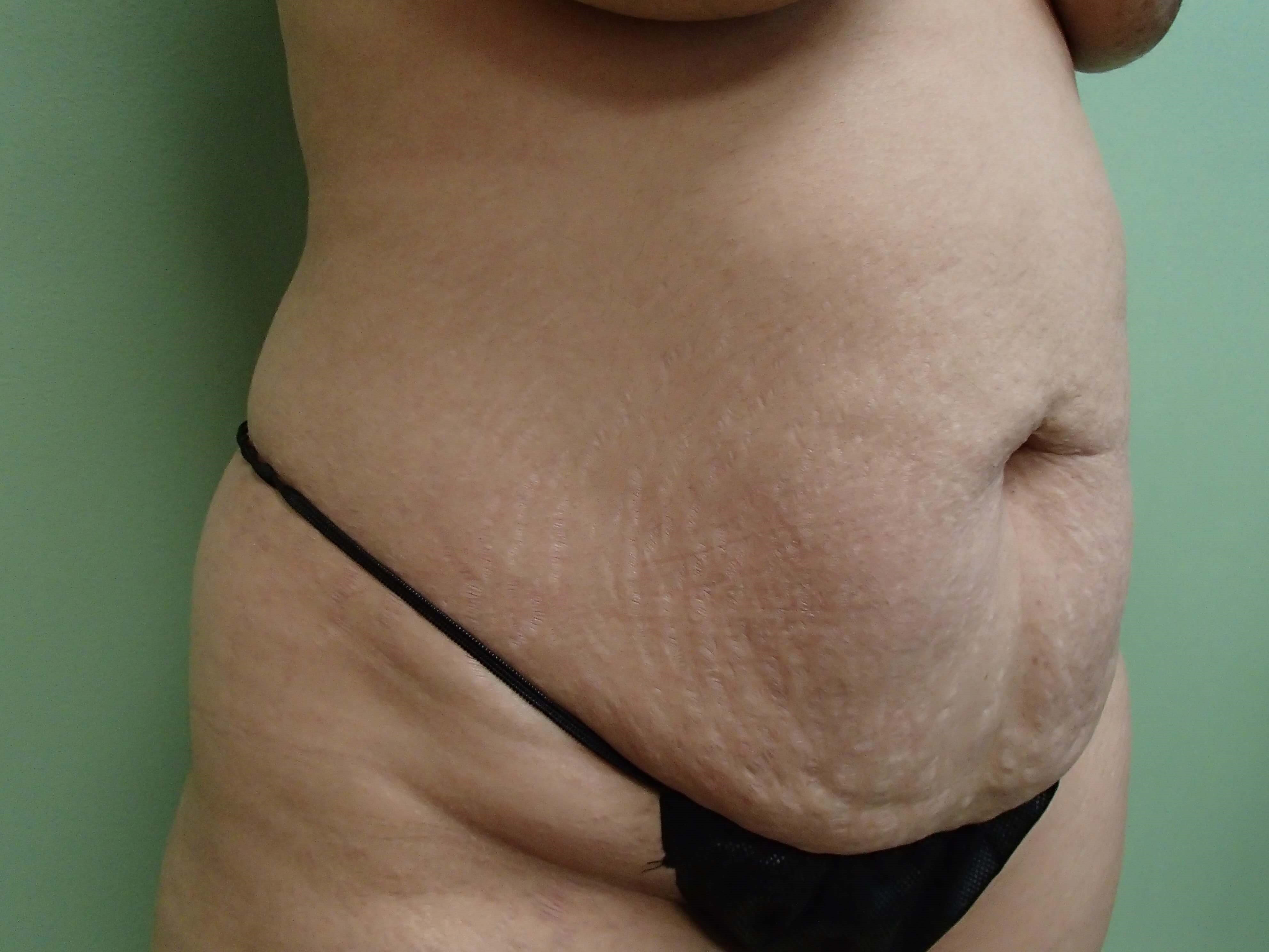 Timeless Tuck - Abdominoplasty Before