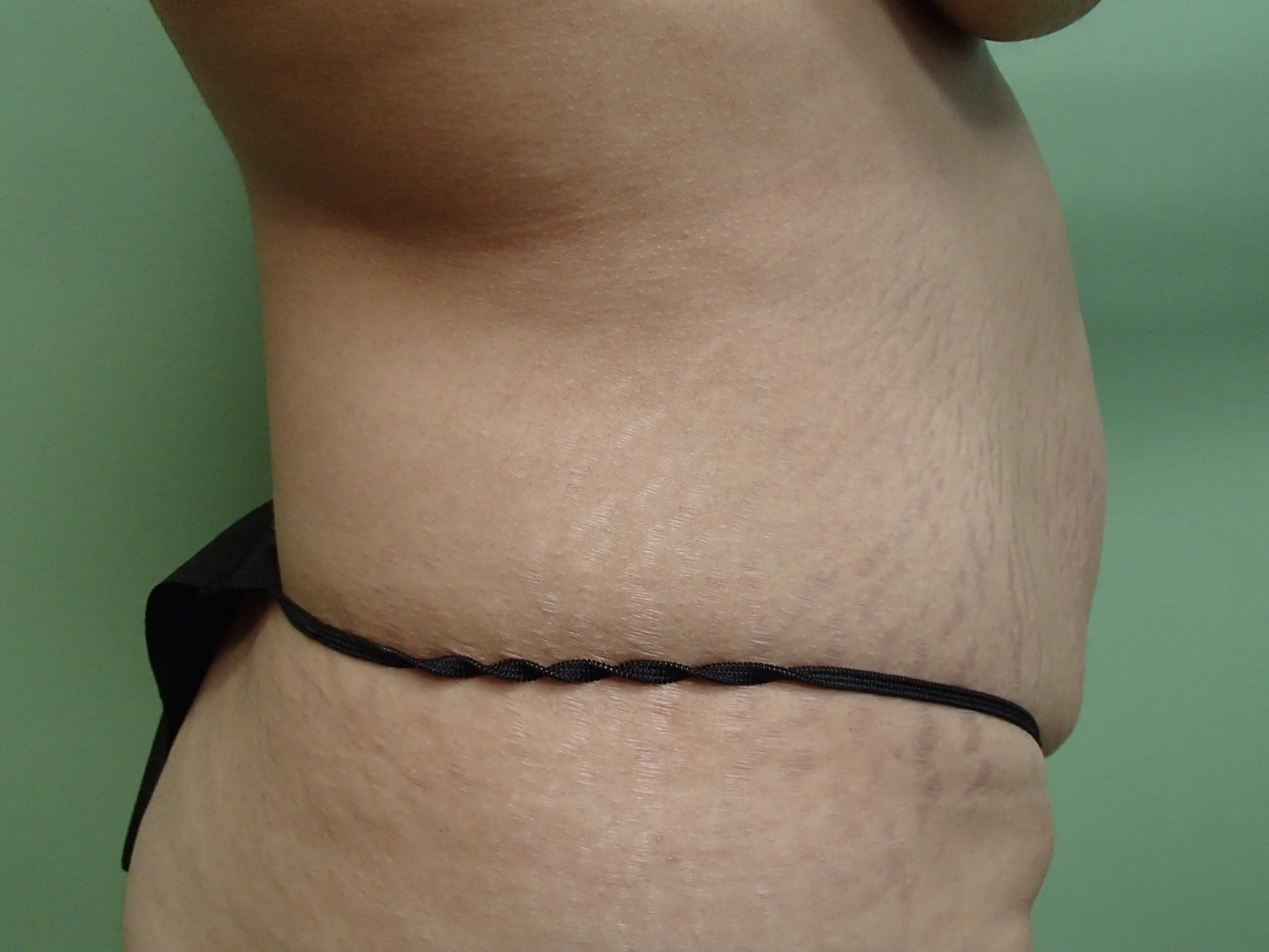 Timeless Tuck - Abdominoplasty Before