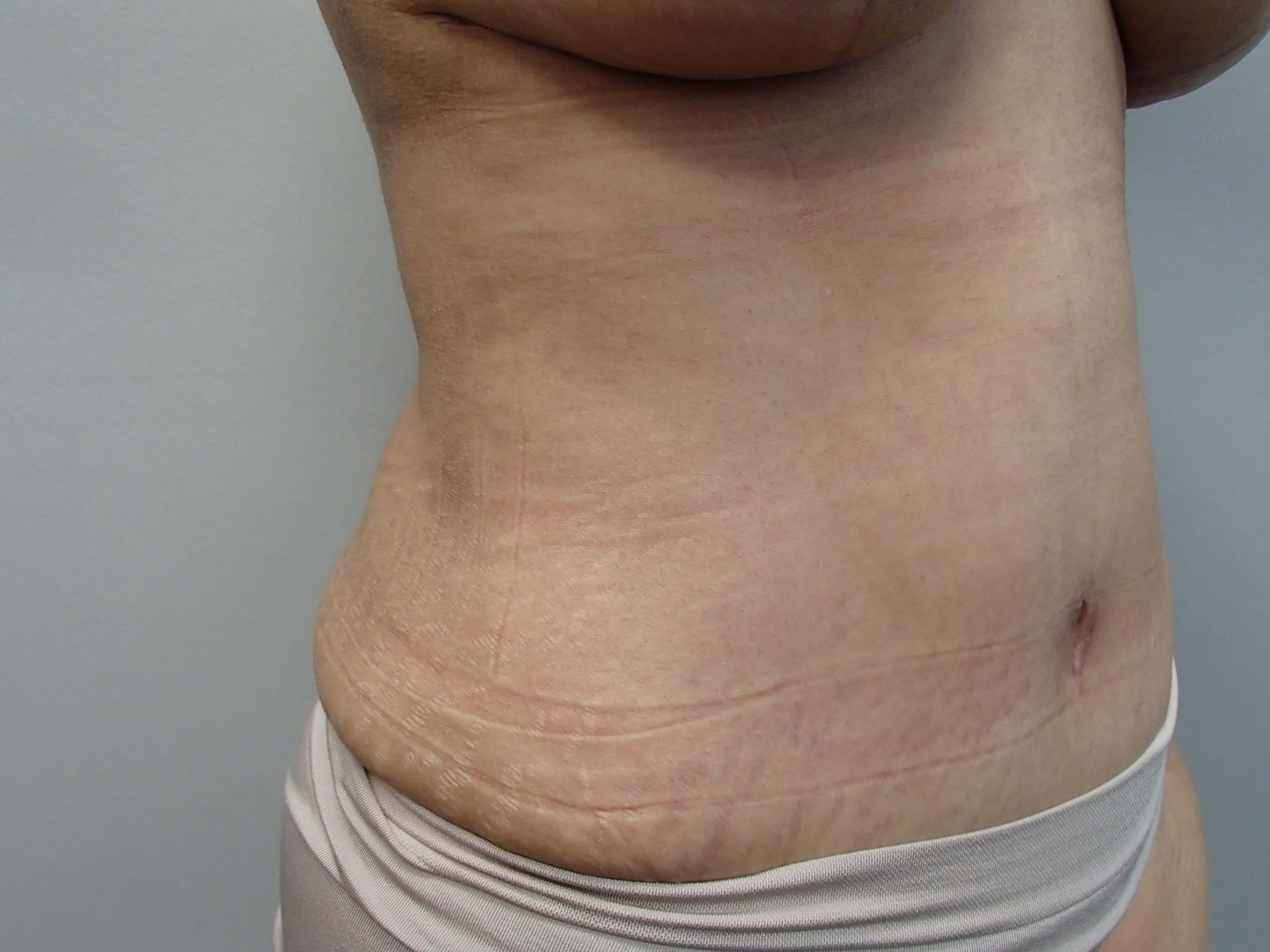 Timeless Tuck - Abdominoplasty After