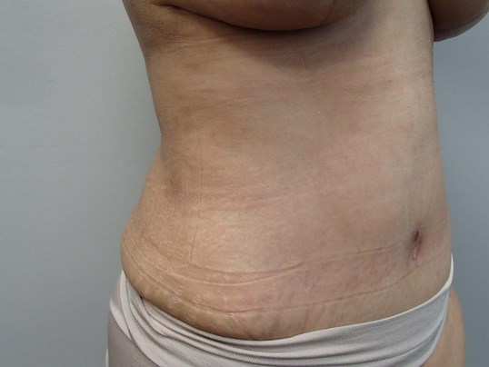 Timeless Tuck - Abdominoplasty After