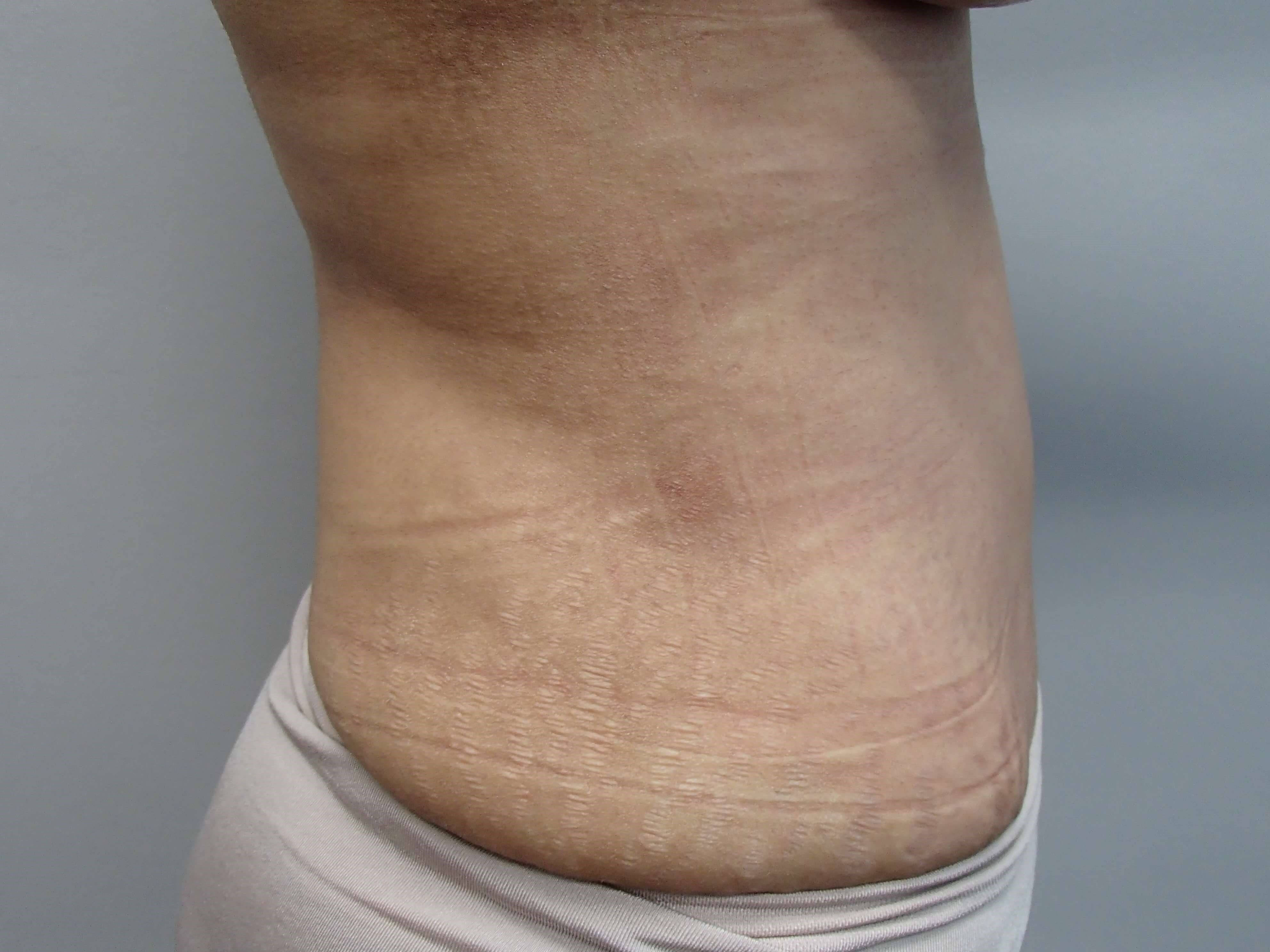 Timeless Tuck - Abdominoplasty After