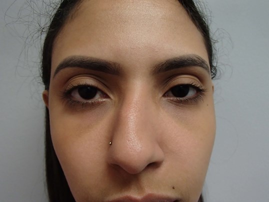Rhinoplasty (Nose Job) Before
