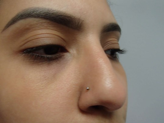 Rhinoplasty (Nose Job) Before