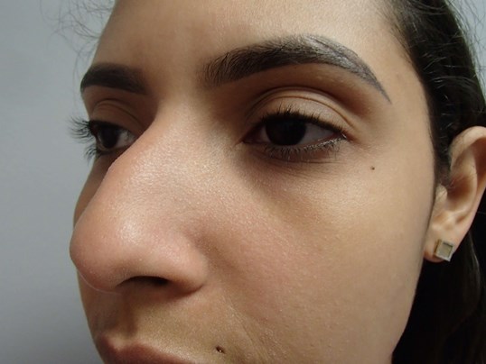 Rhinoplasty (Nose Job) Before
