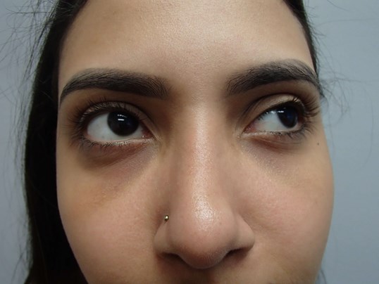 Rhinoplasty (Nose Job) After