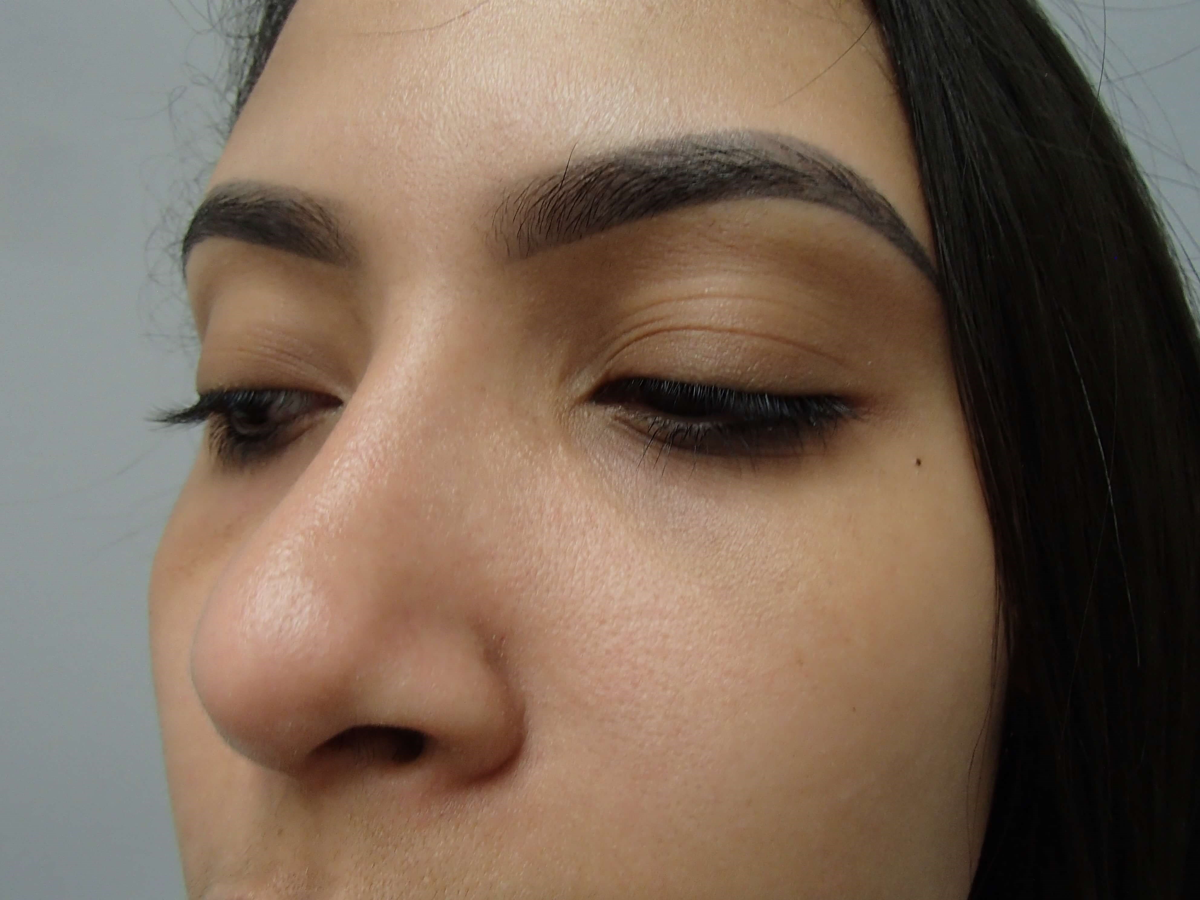 Rhinoplasty (Nose Job) After