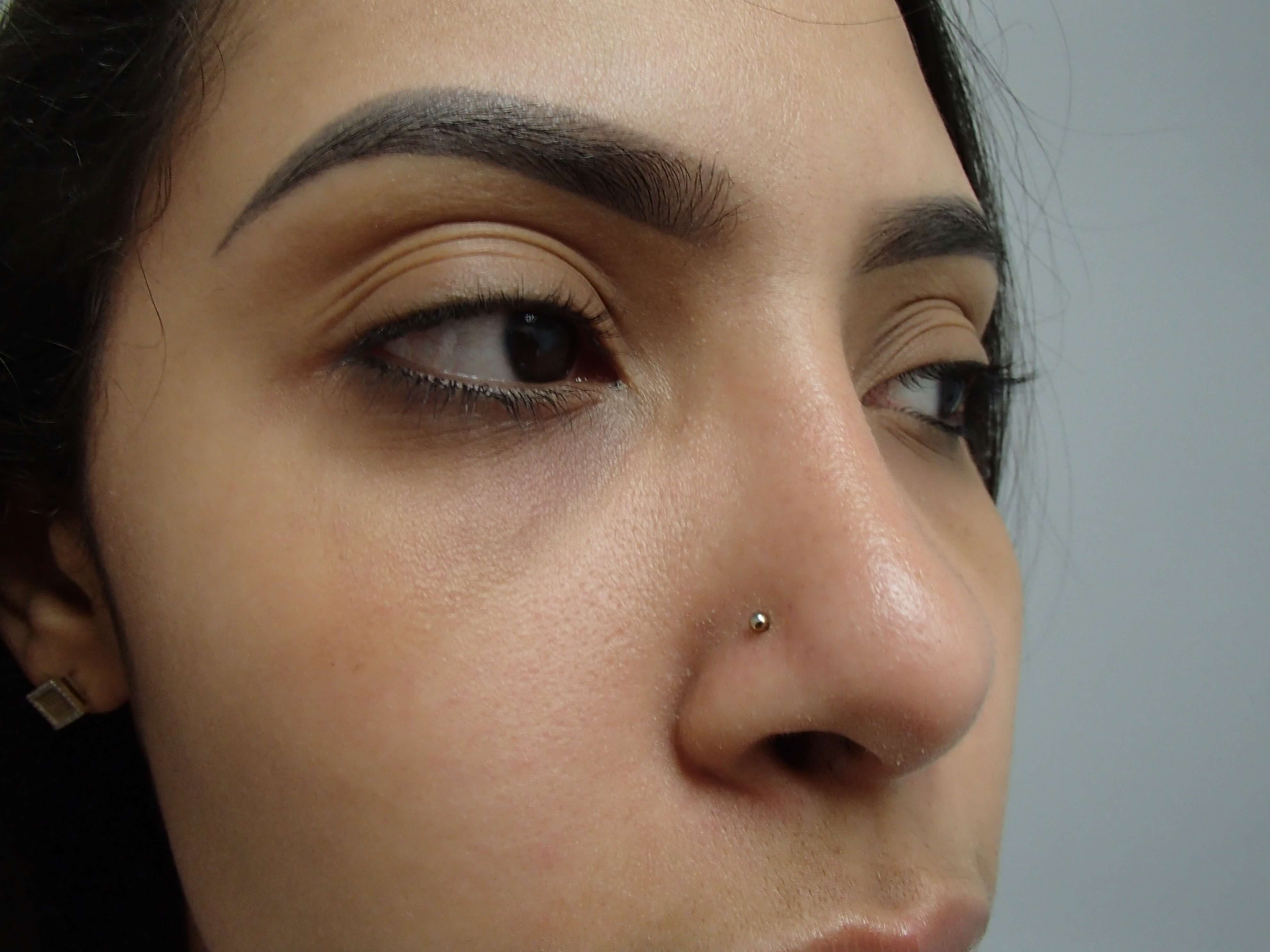 Rhinoplasty (Nose Job) After