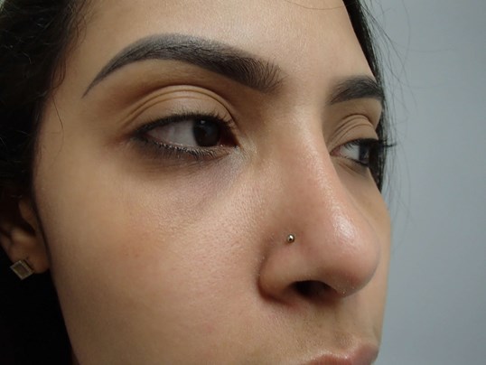 Rhinoplasty (Nose Job) After