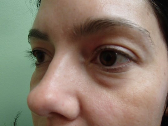 Blepharoplasty - Eye Lid Lift Before
