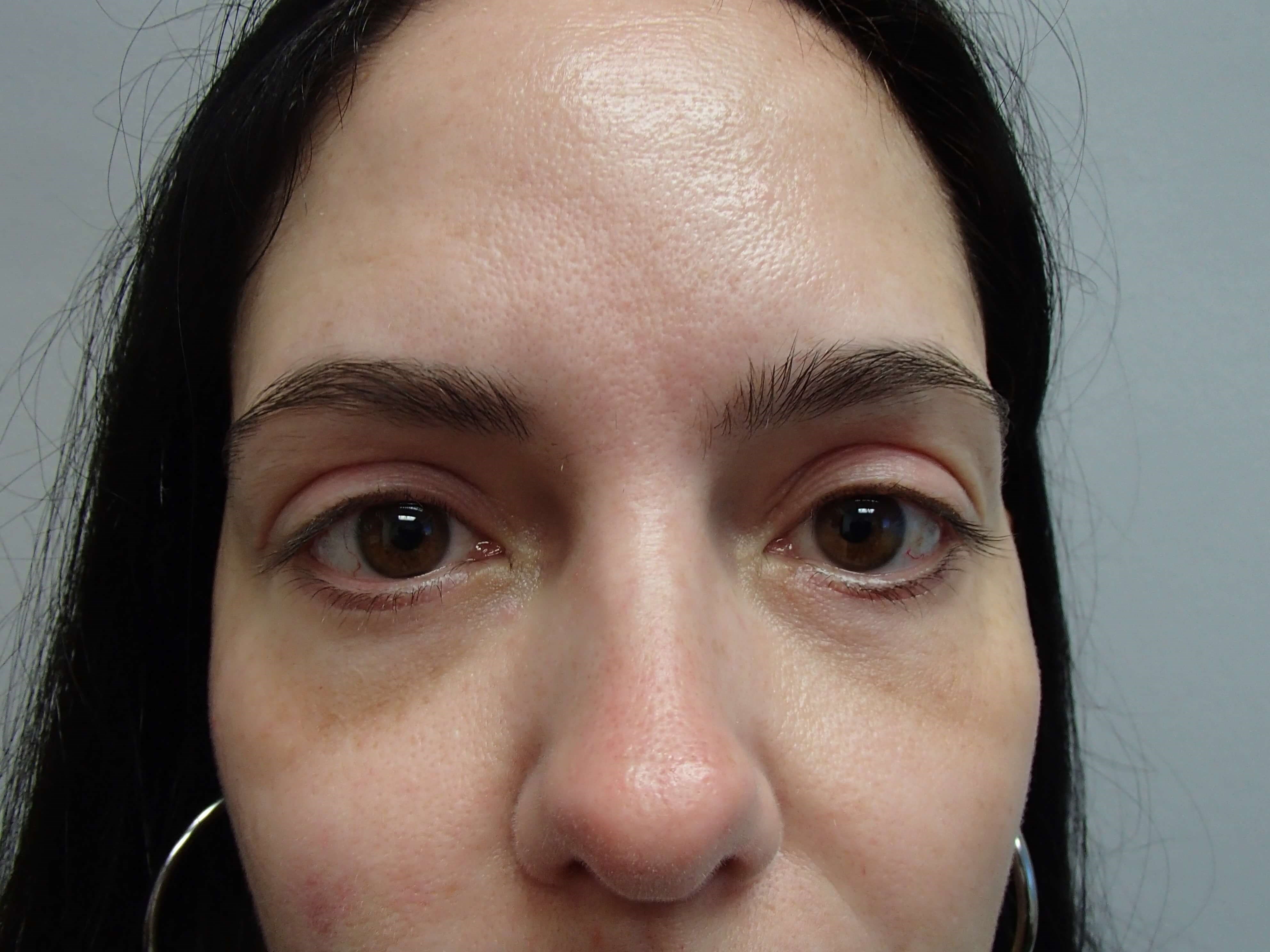 Blepharoplasty - Eye Lid Lift After