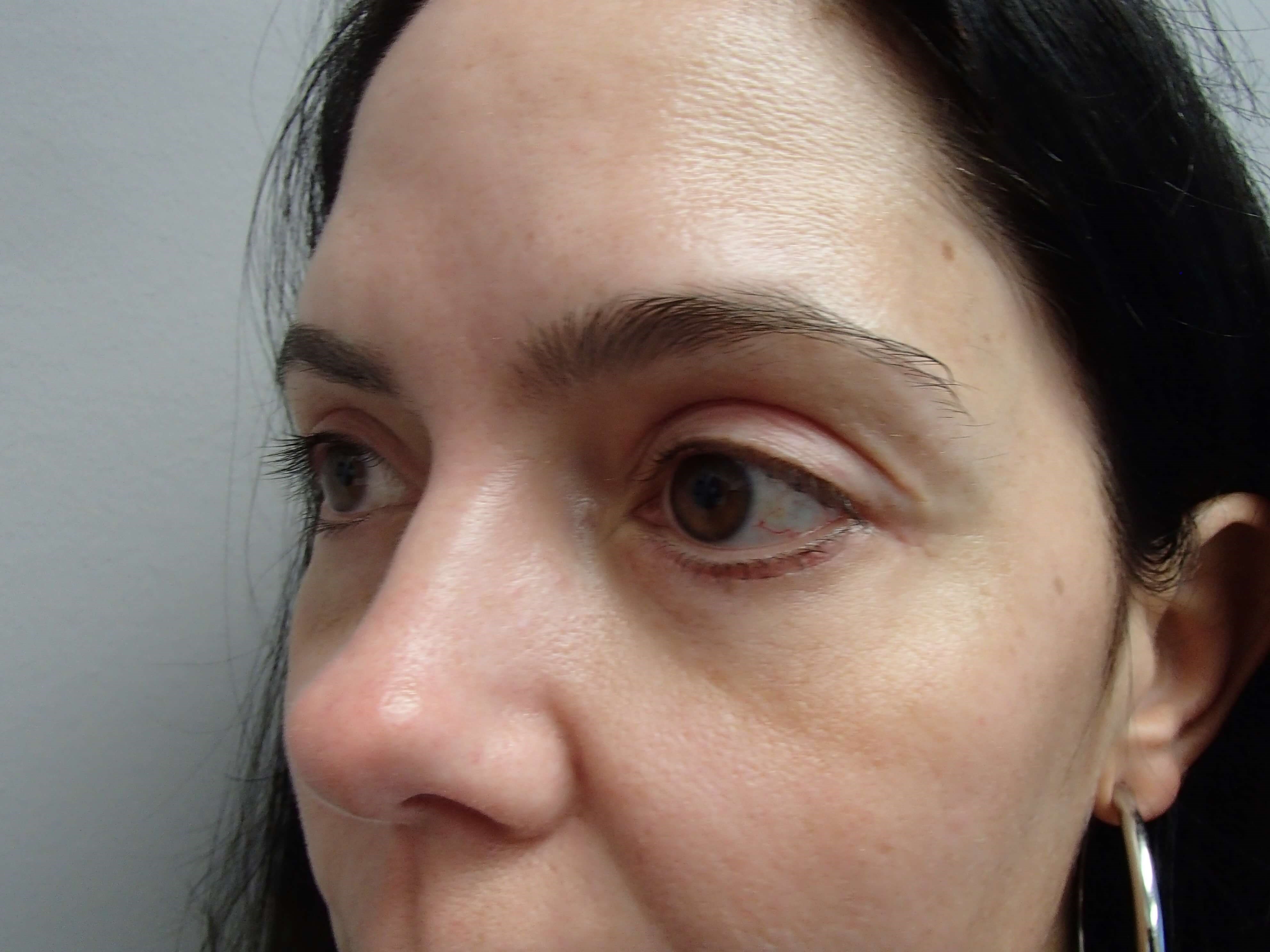Blepharoplasty - Eye Lid Lift After