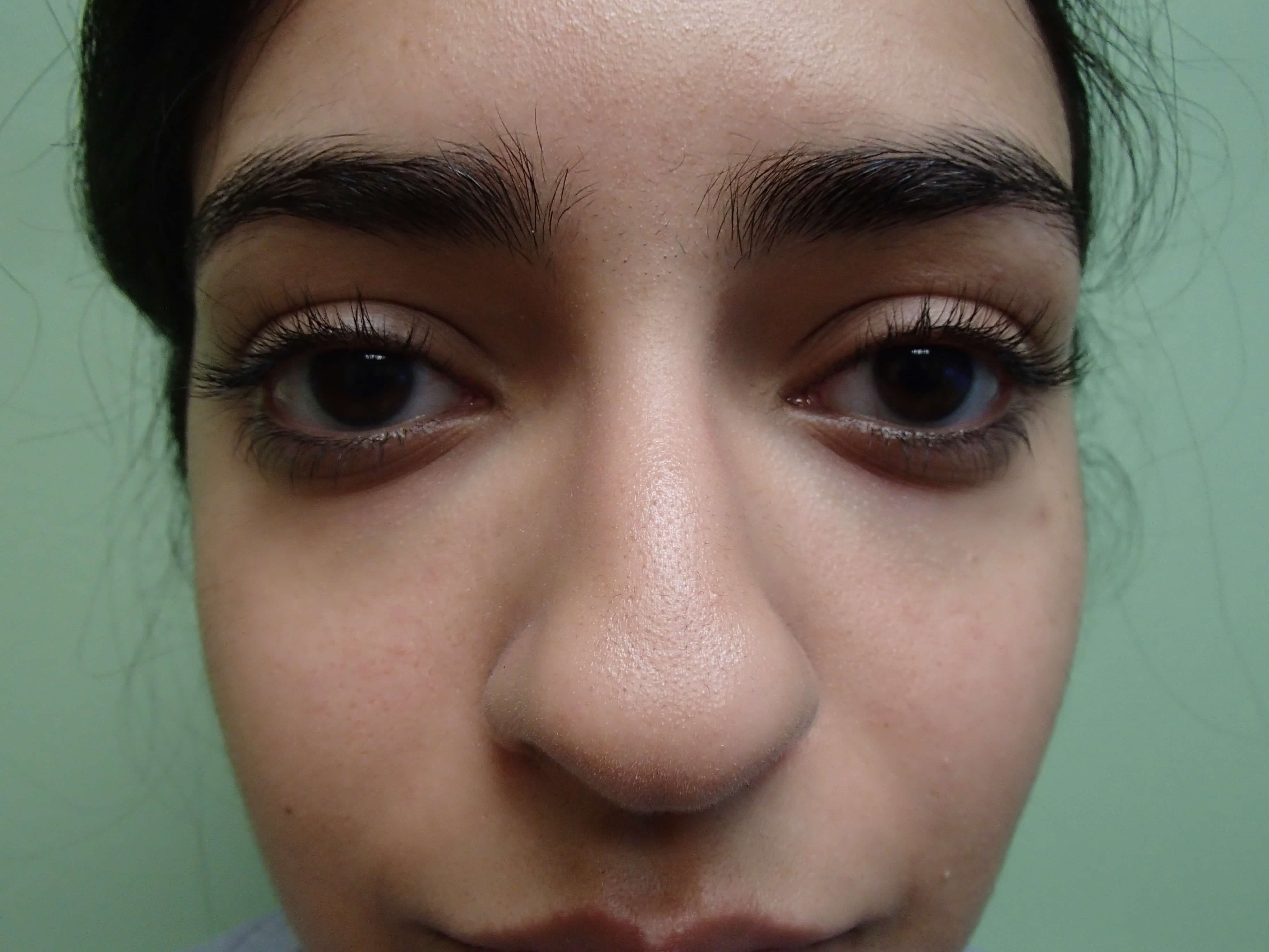 Rhinoplasty (Nose Job) Before
