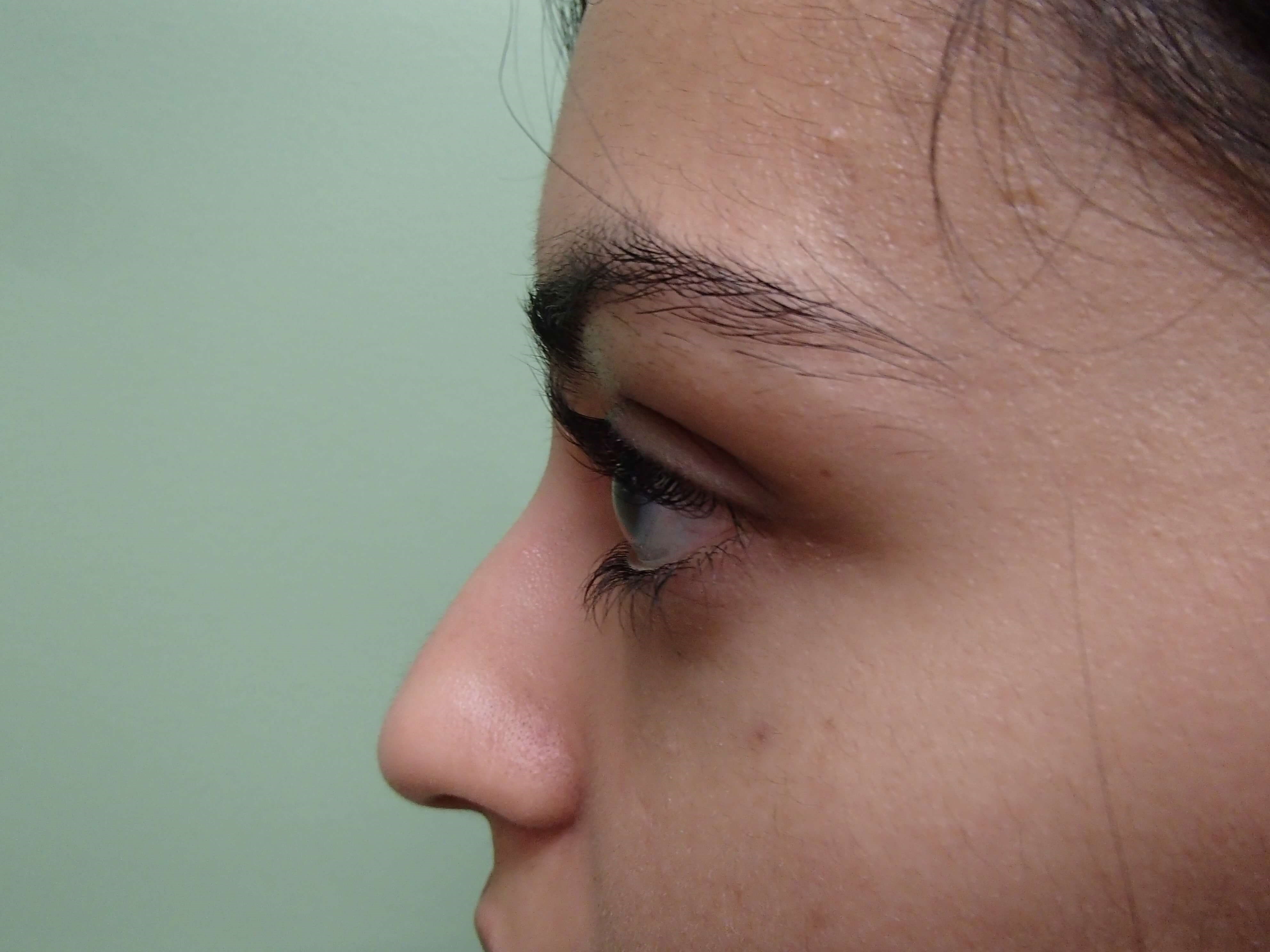 Rhinoplasty (Nose Job) Before