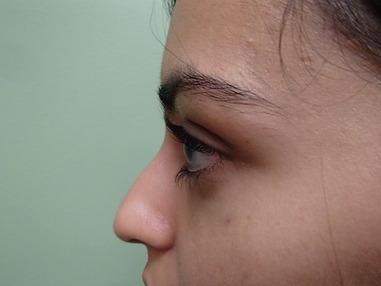 Rhinoplasty (Nose Job) Before