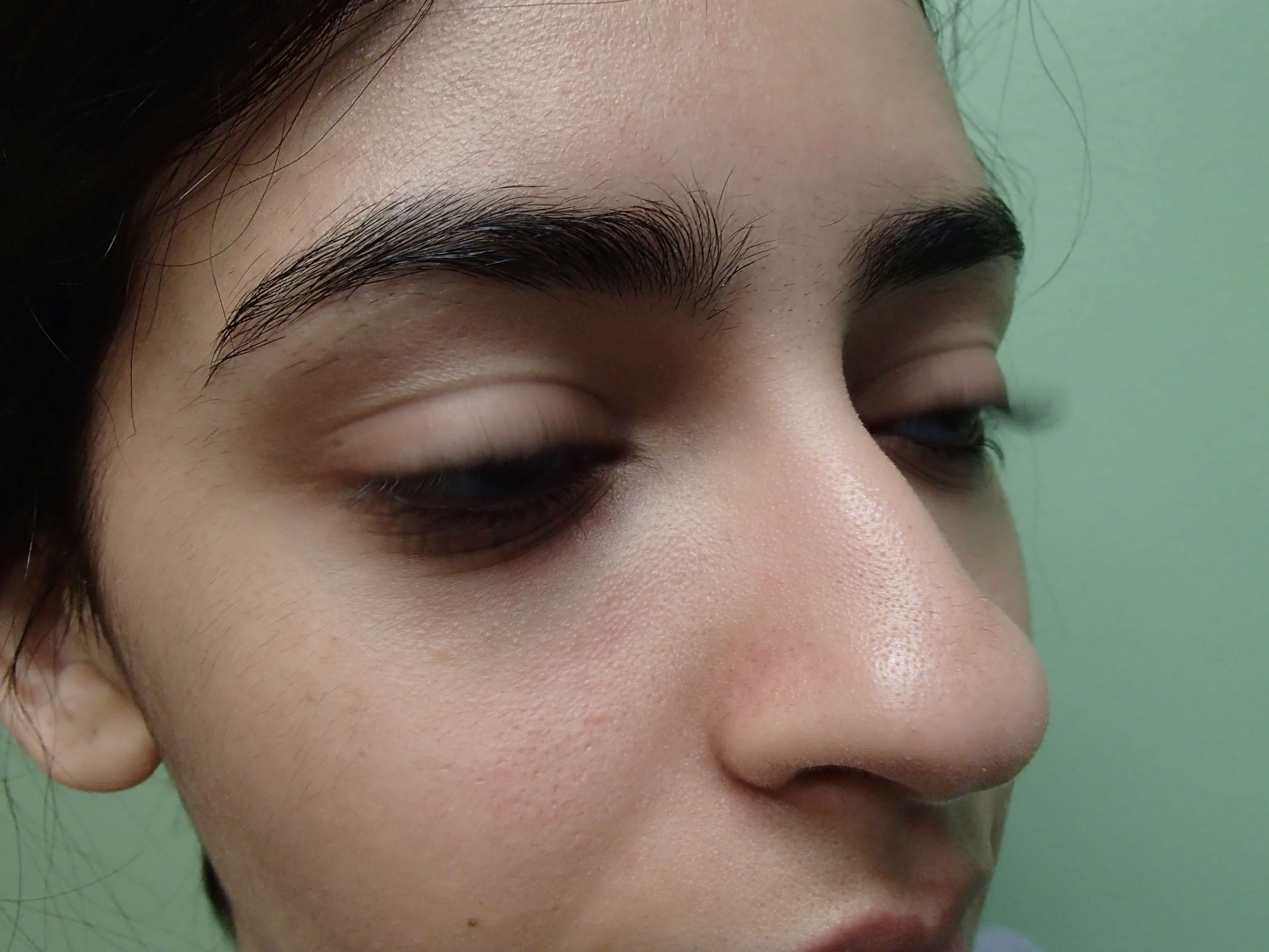 Rhinoplasty (Nose Job) Before