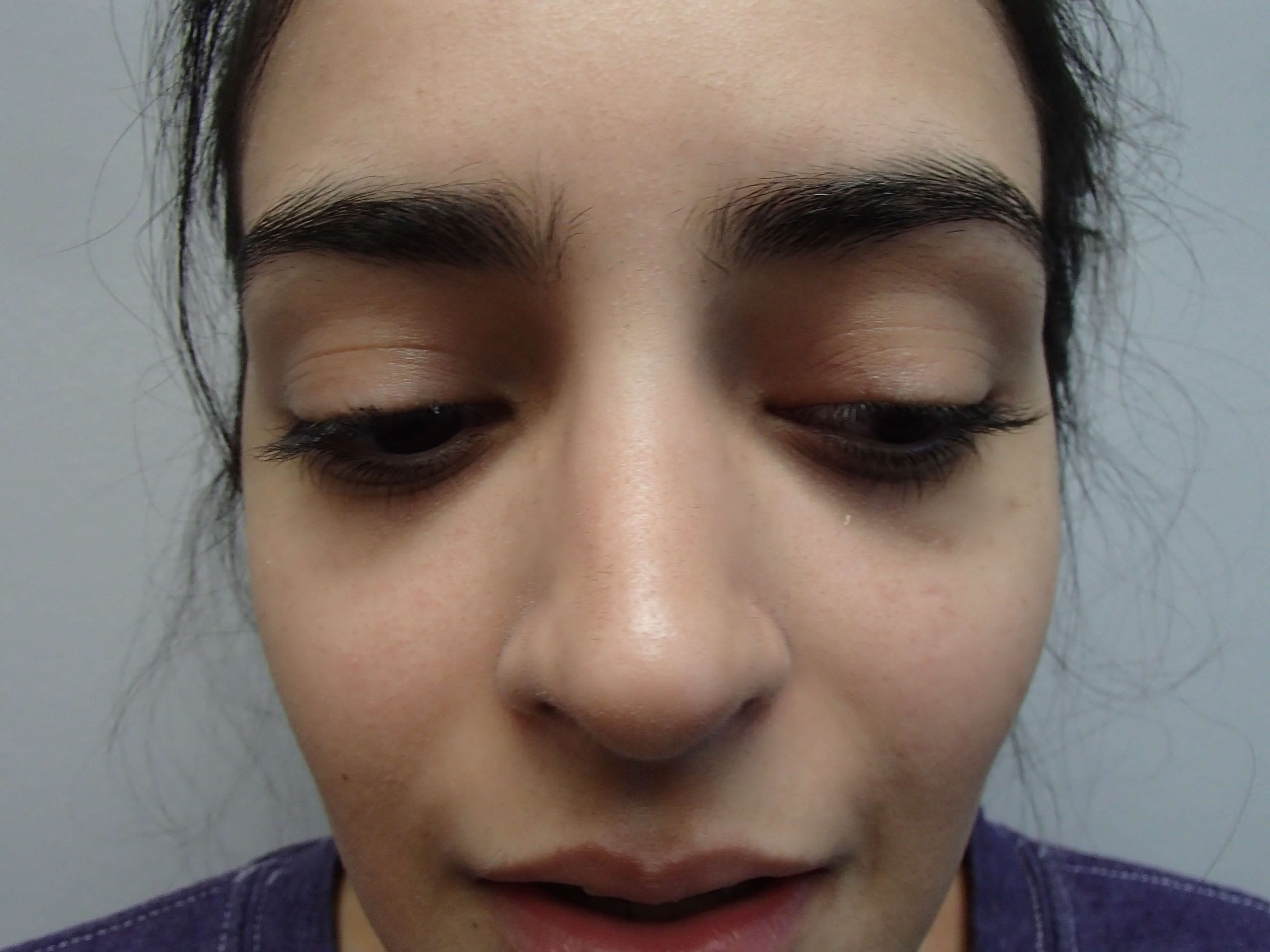 Rhinoplasty (Nose Job) After