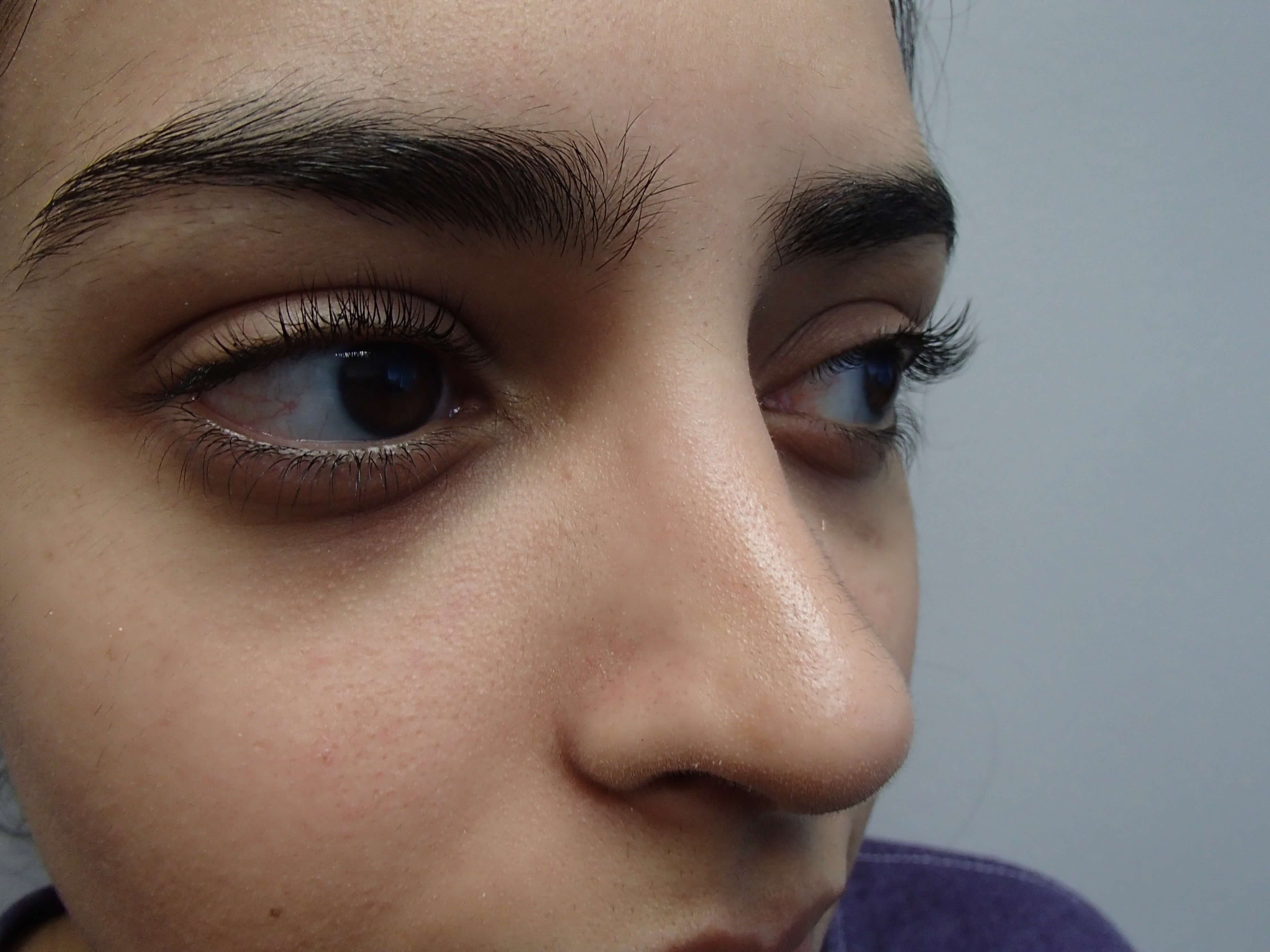 Rhinoplasty (Nose Job) After
