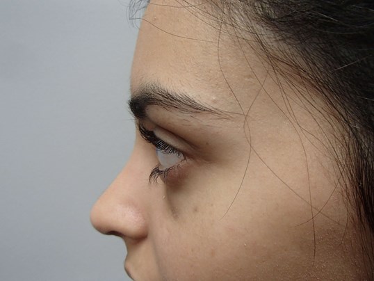 Rhinoplasty (Nose Job) After