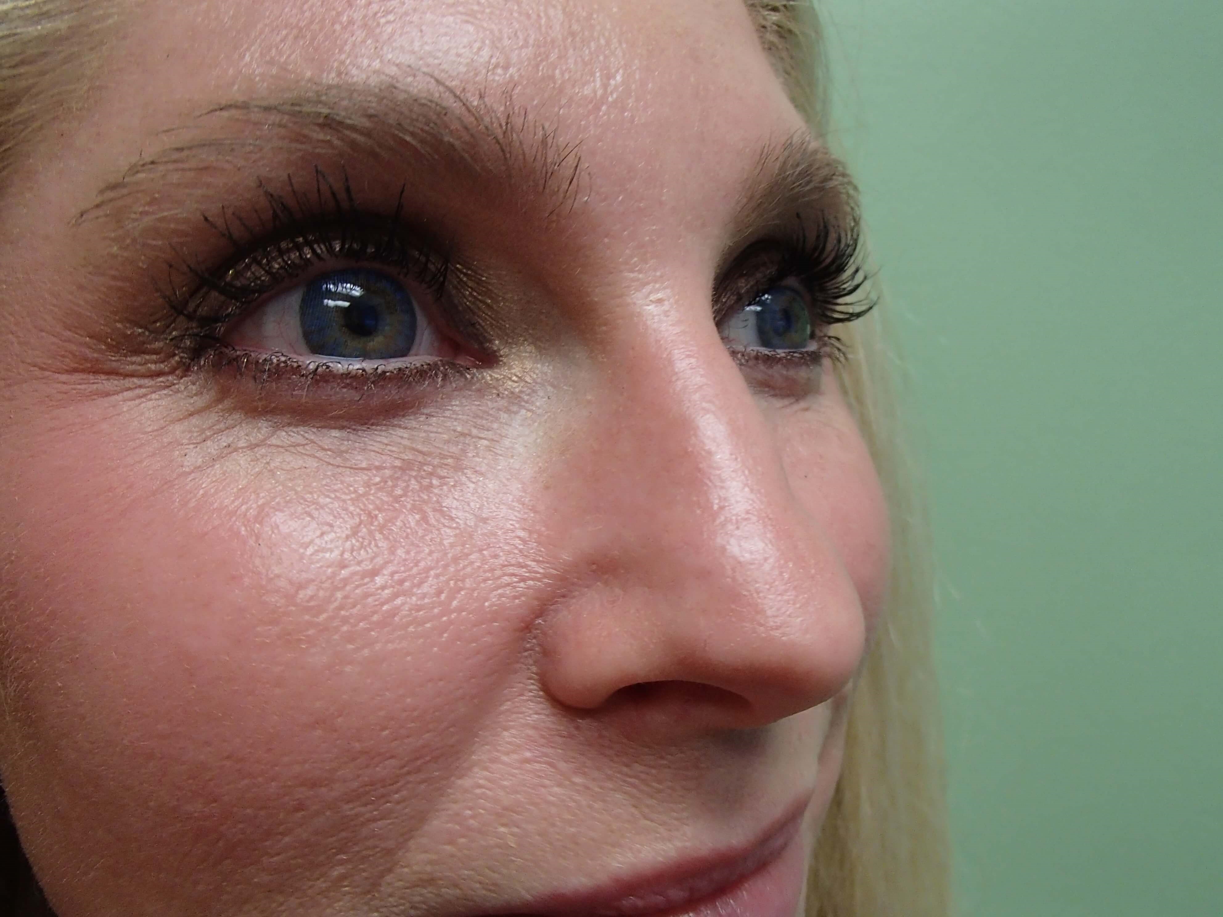 Rhinoplasty (Nose Job) Before