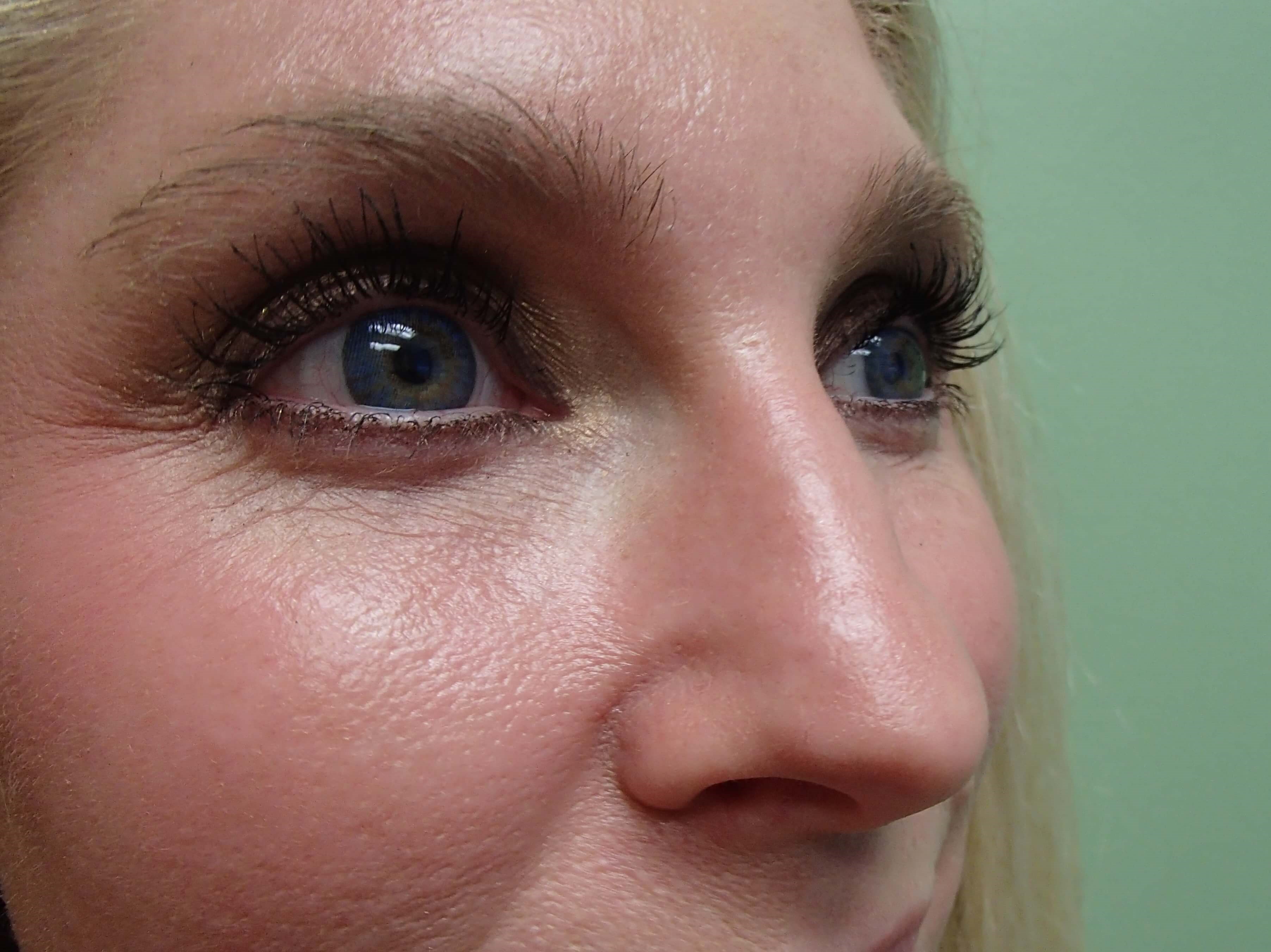 Rhinoplasty (Nose Job) Before