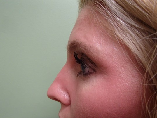 Rhinoplasty (Nose Job) Before