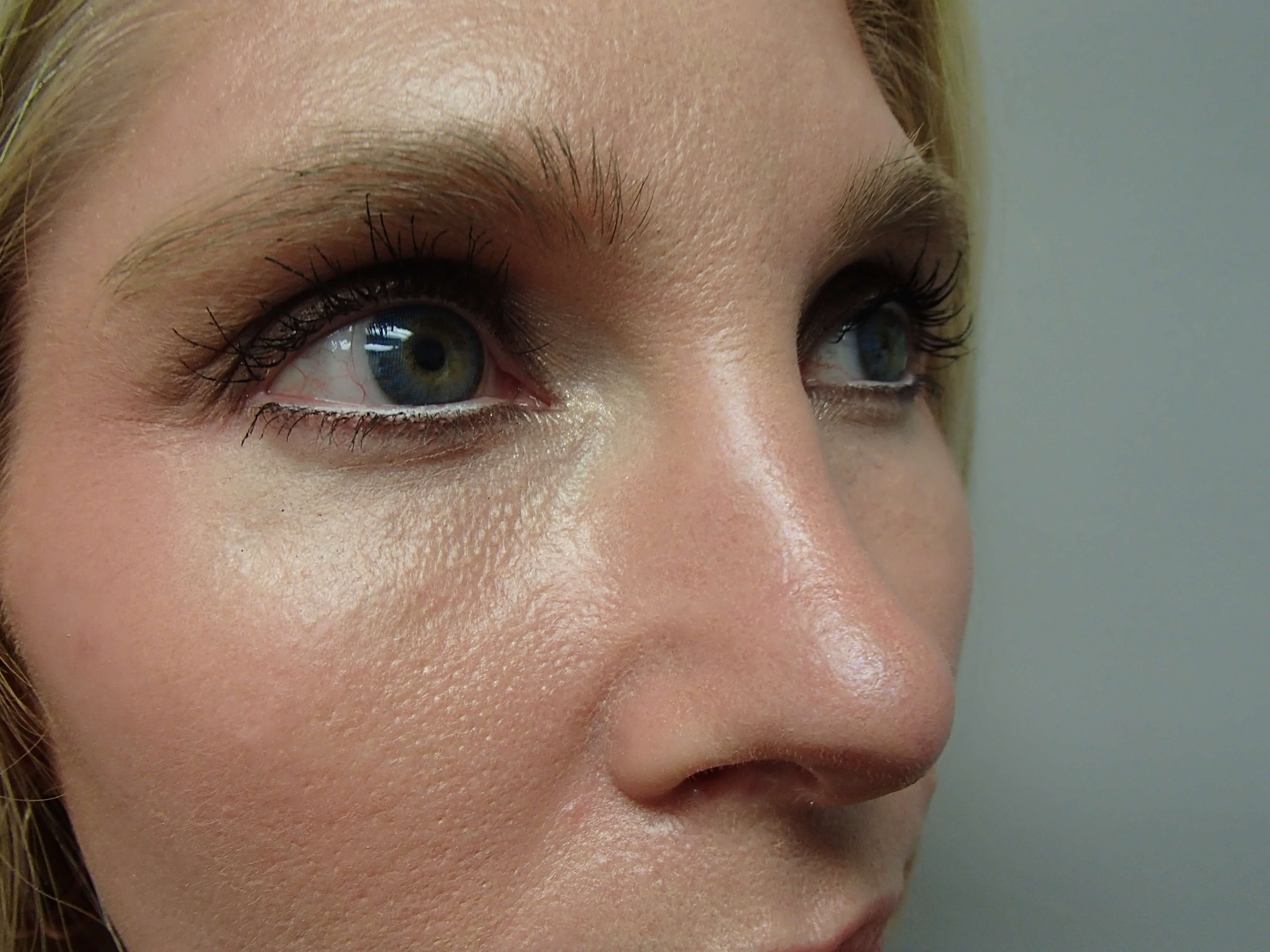 Rhinoplasty (Nose Job) After