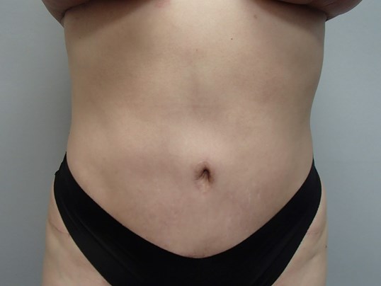 Timeless Tuck - Abdominoplasty After