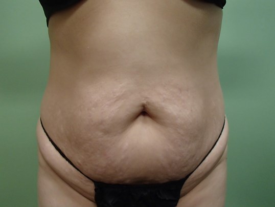 Timeless Tuck - Abdominoplasty Before