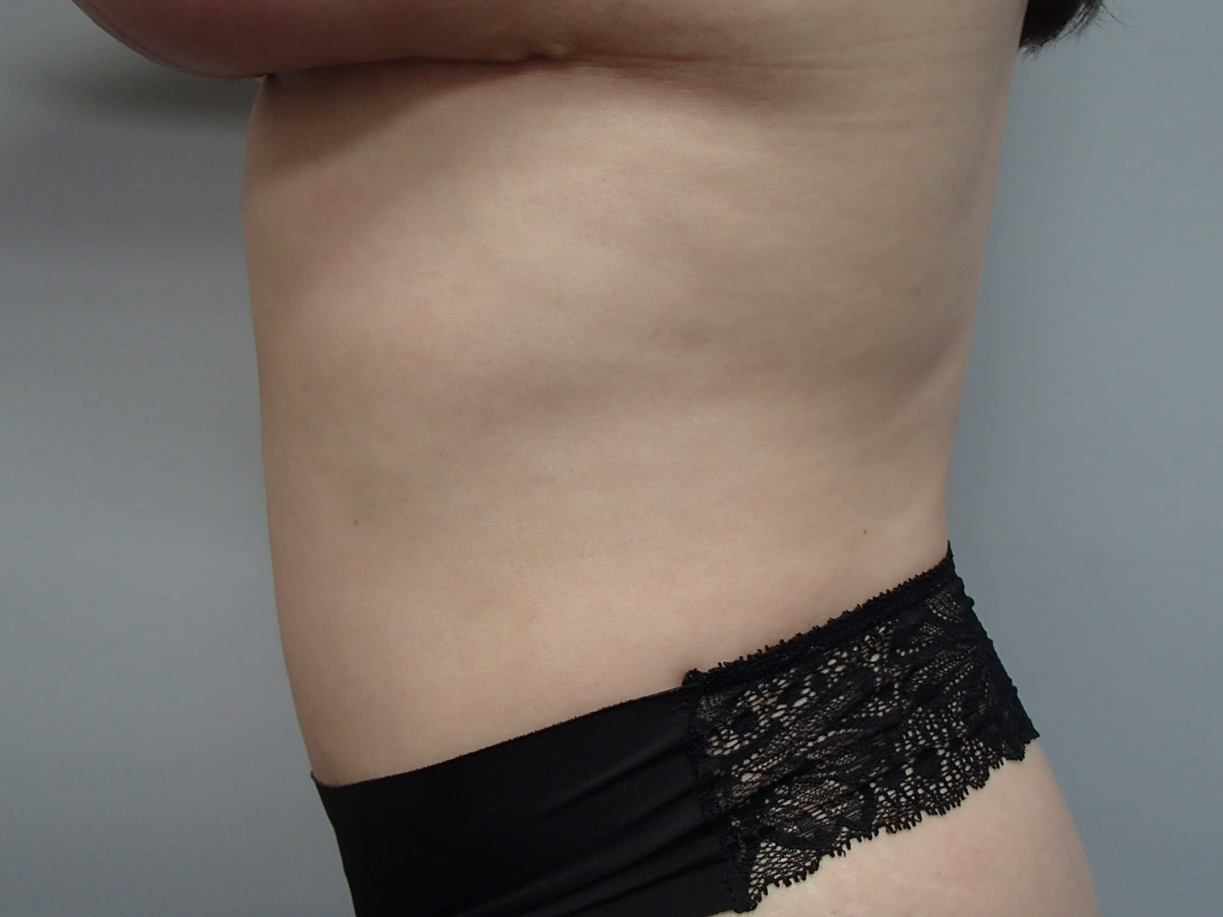 Timeless Tuck - Abdominoplasty After