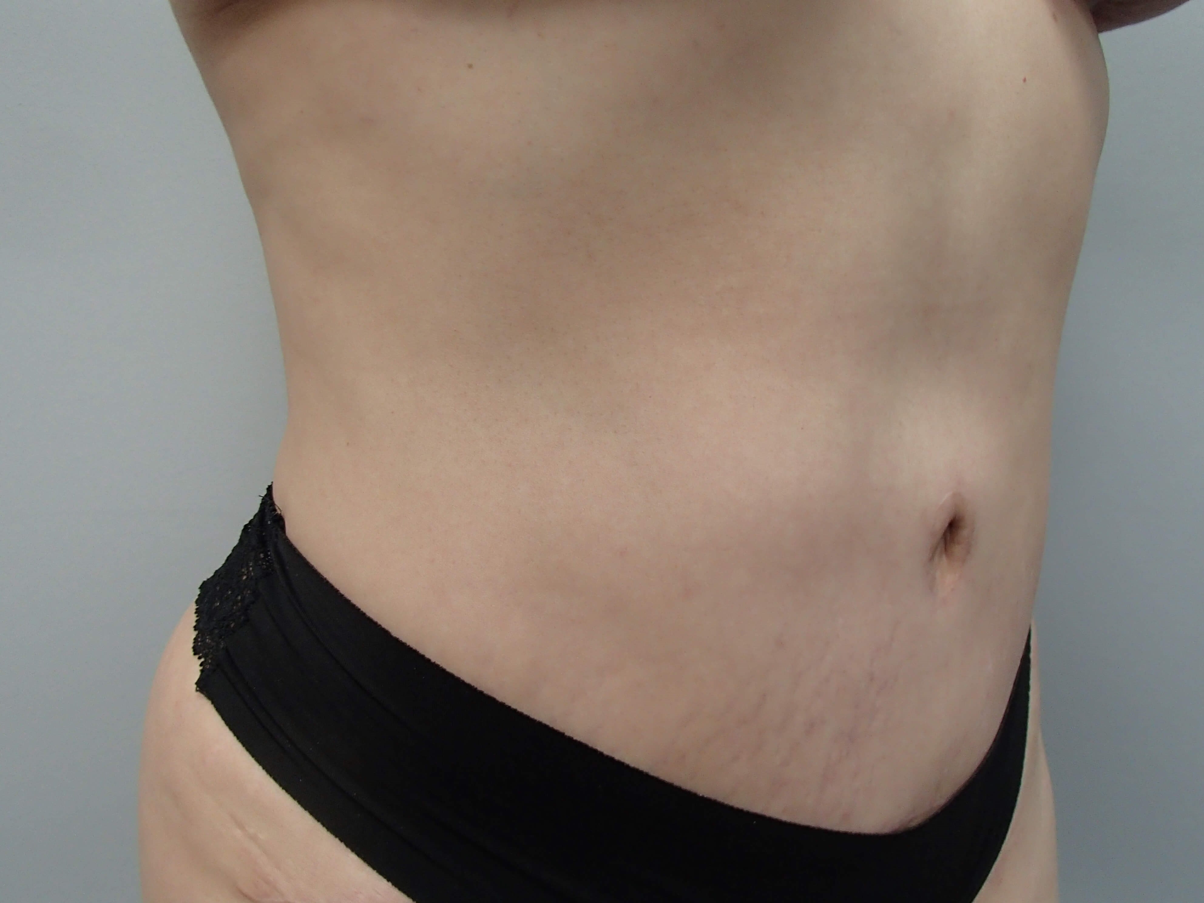 Timeless Tuck - Abdominoplasty After