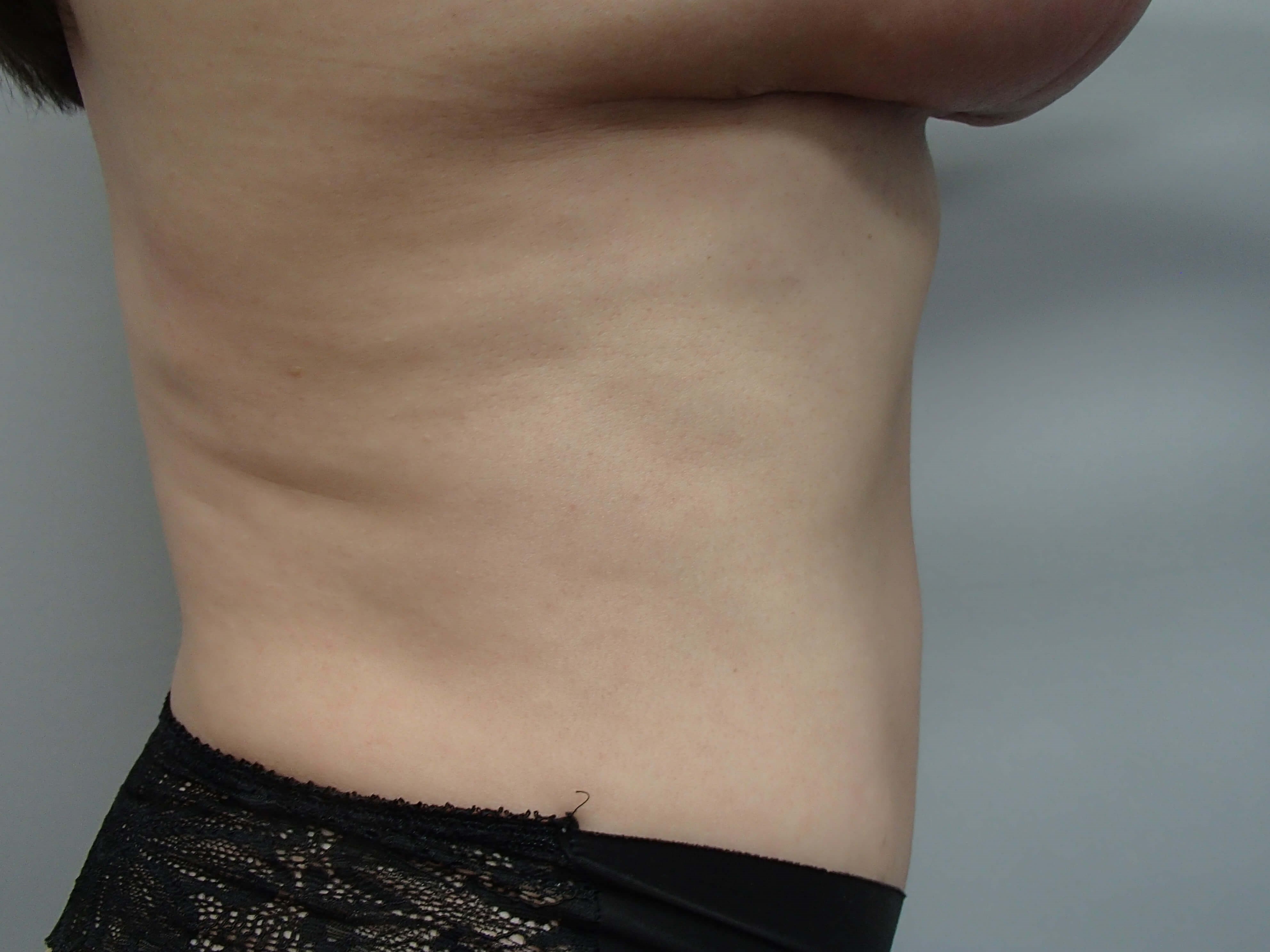 Timeless Tuck - Abdominoplasty After