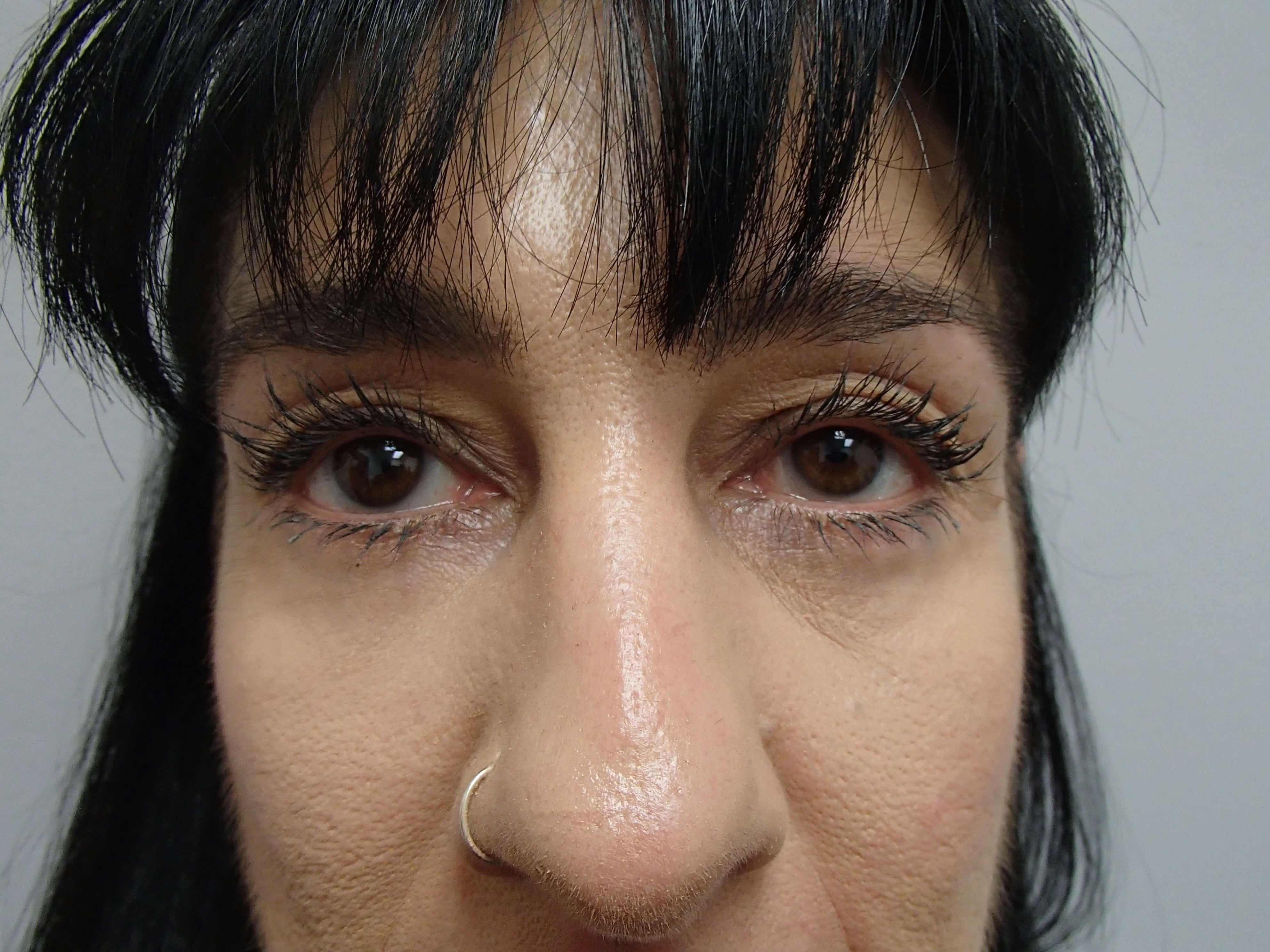 Lower Eyelid Lift After