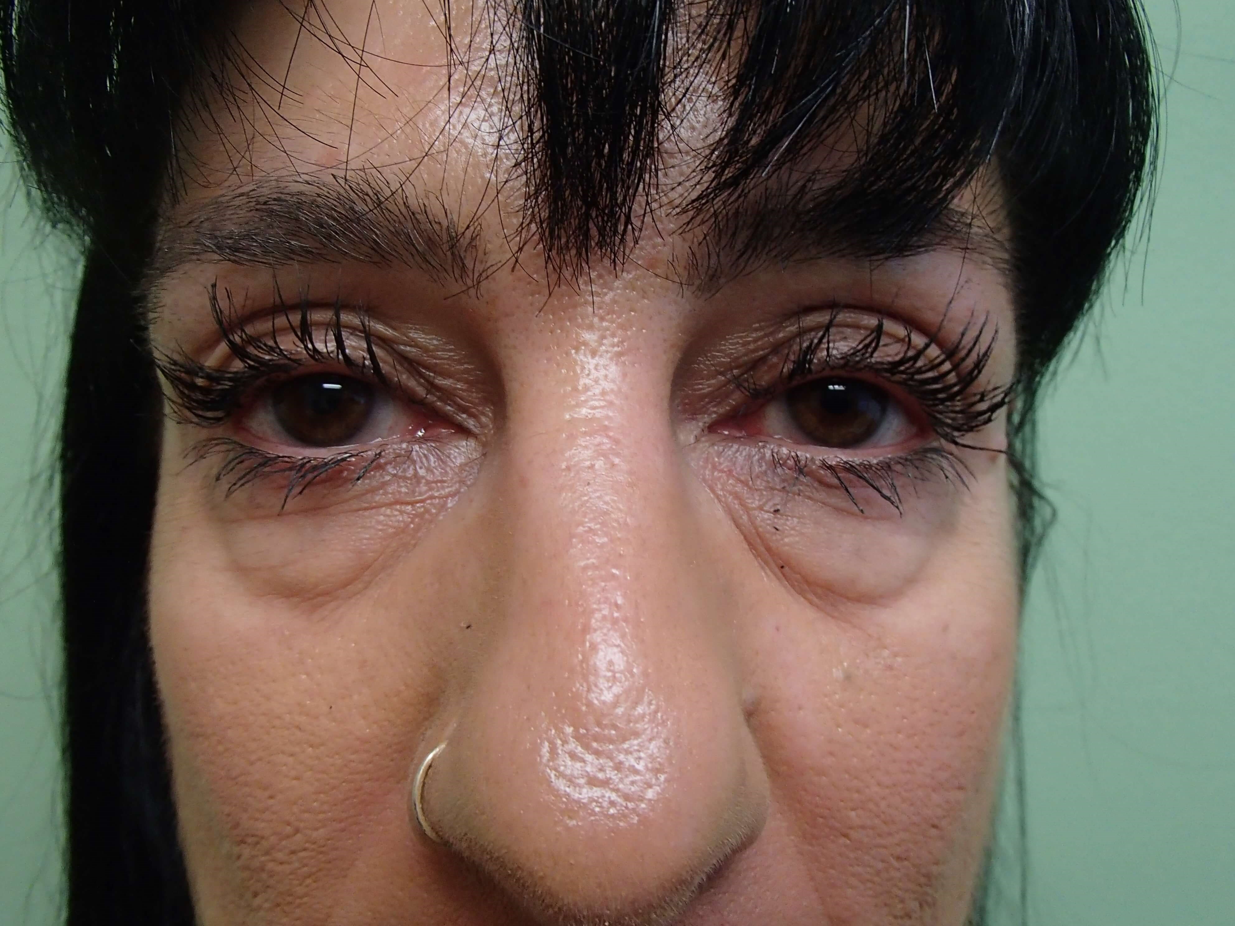 Lower Eyelid Lift Before