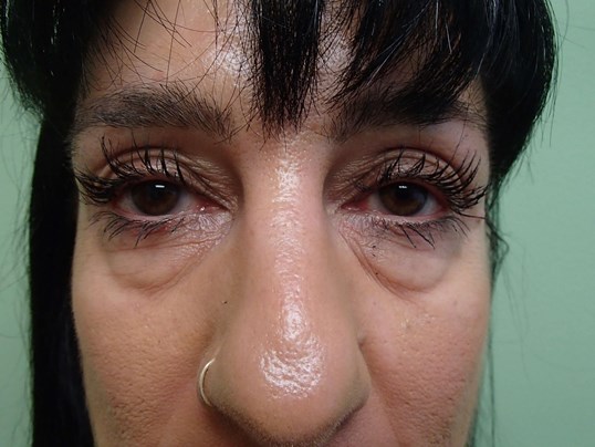 Lower Eyelid Lift Before