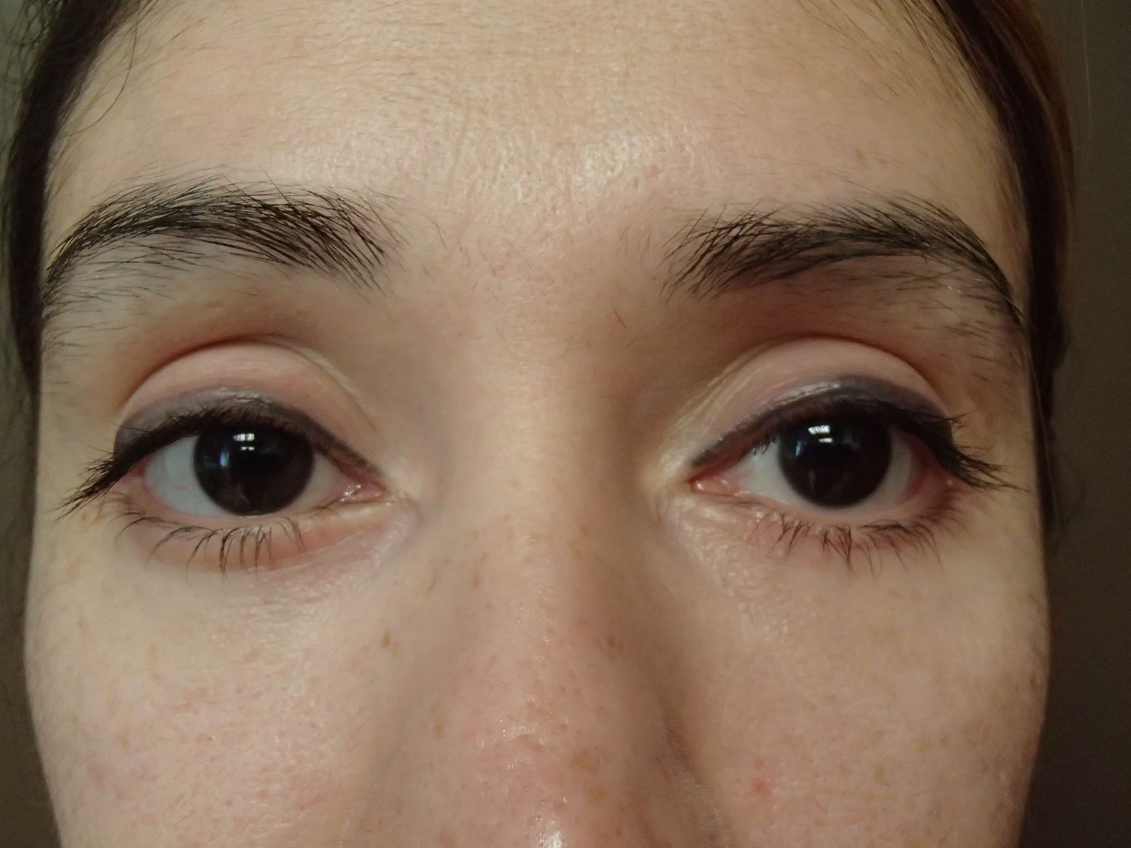 Blepharoplasty After