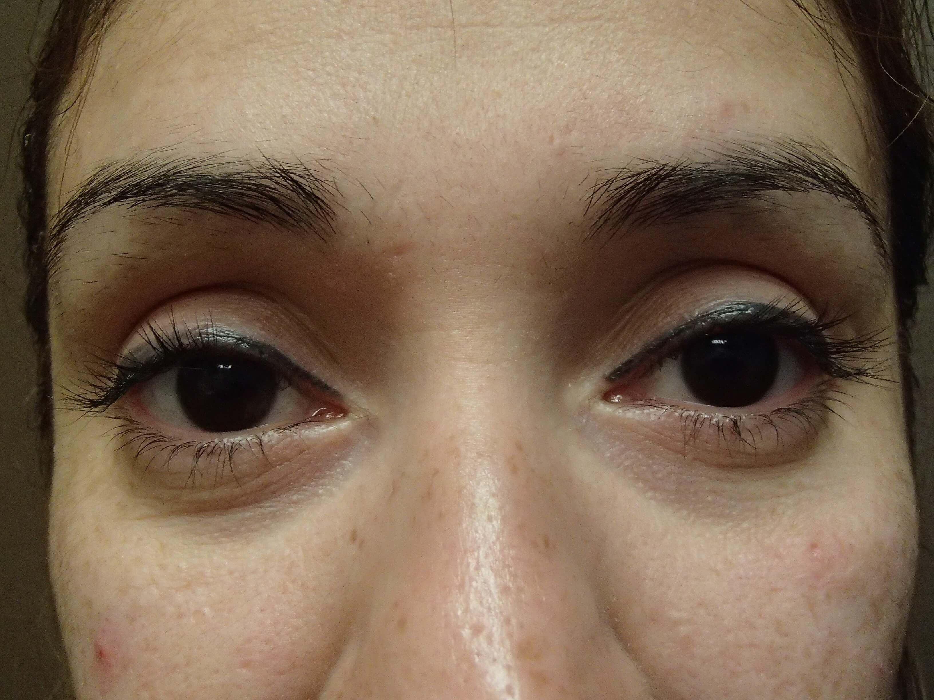 Blepharoplasty Before