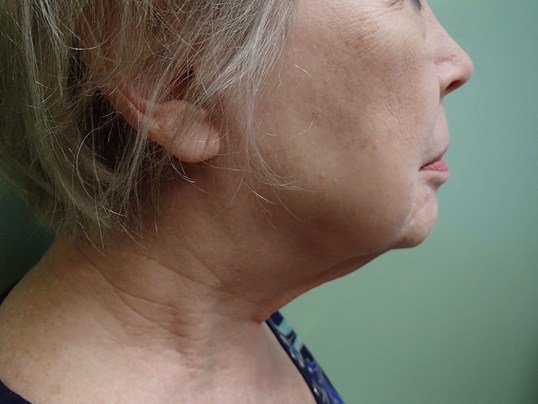 Facelift/Necklift Before