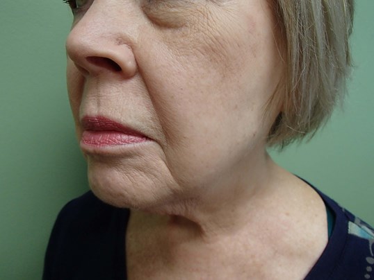 Facelift/Necklift Before