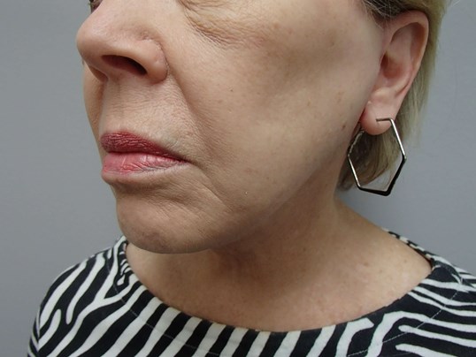 Facelift/Necklift After