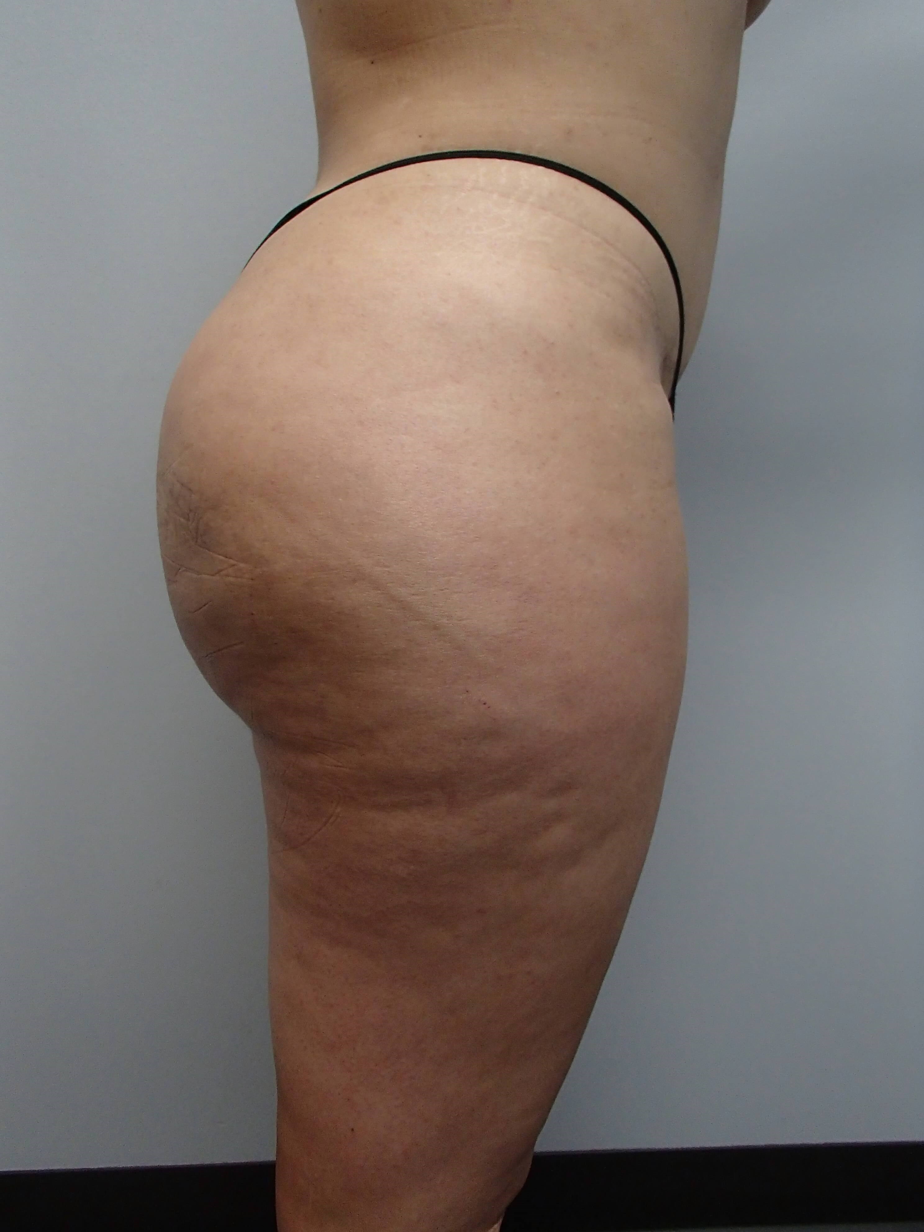 Brazilian Butt Lift After