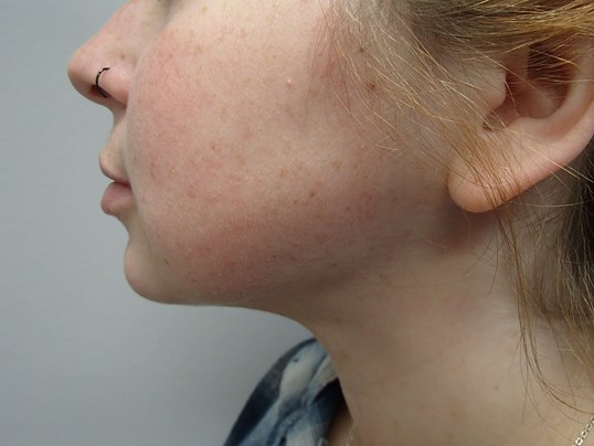 Neck Liposuction After