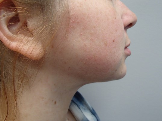 Neck Liposuction After