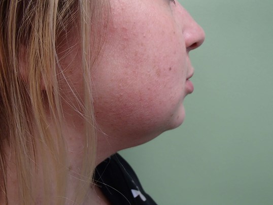 Neck Liposuction Before