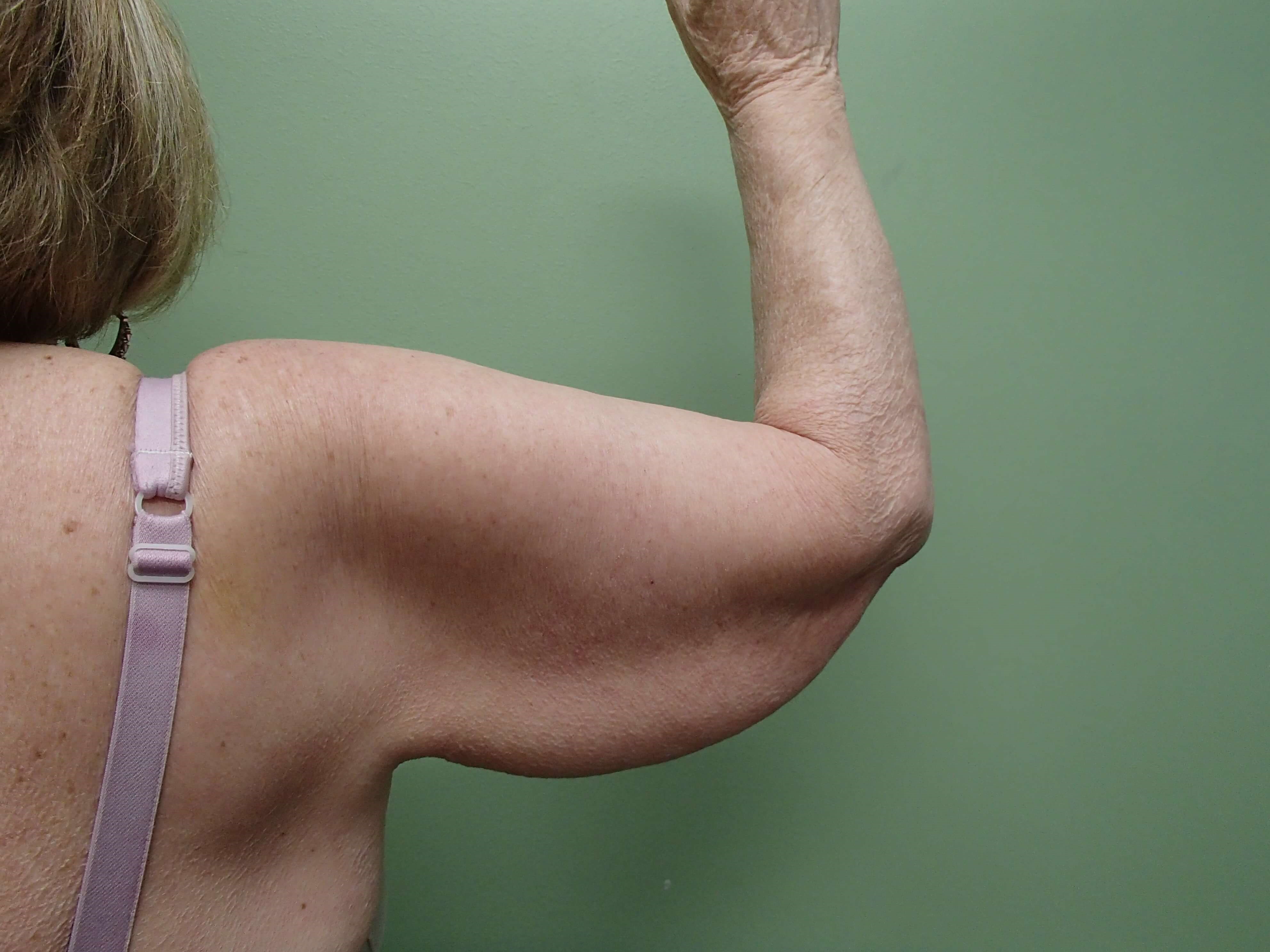 Brachioplasty (Arm Lift) Before