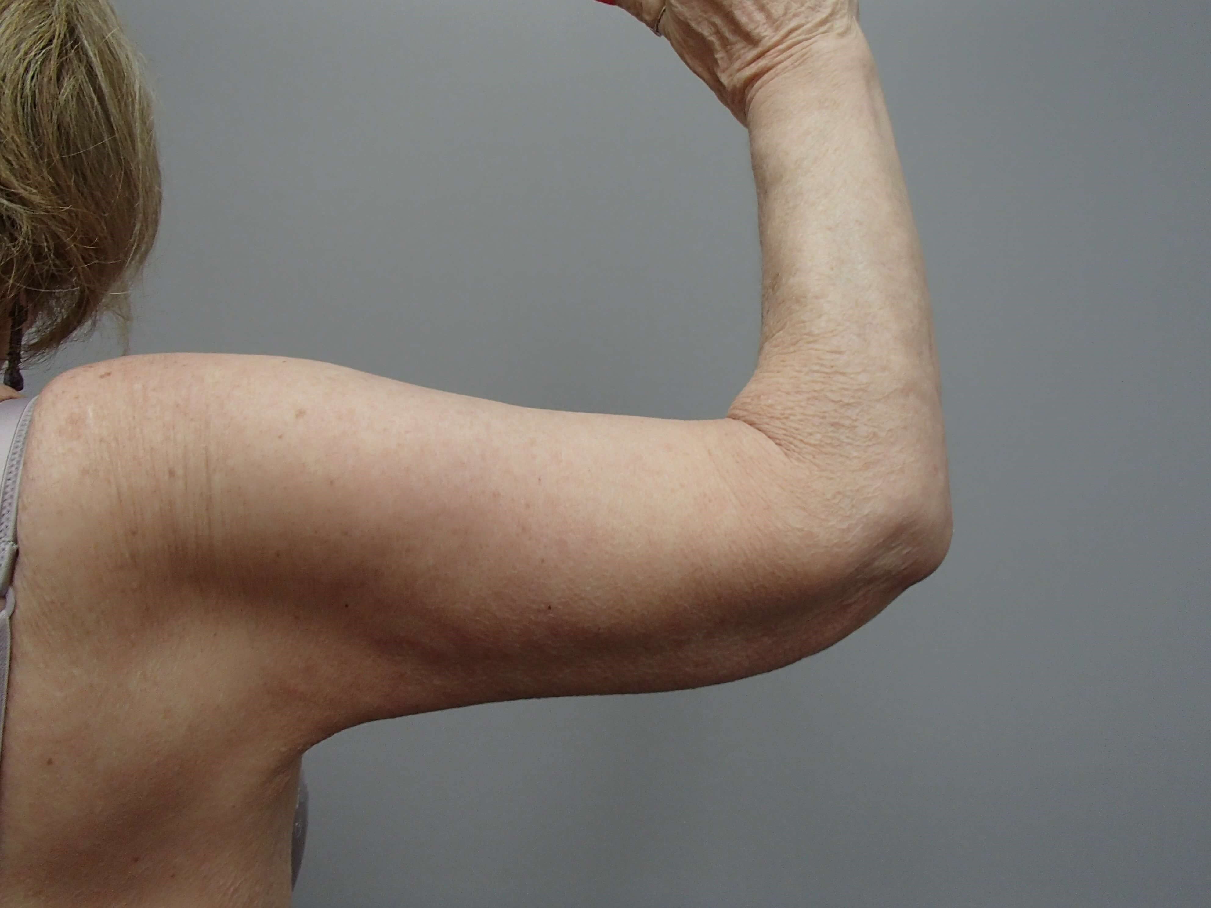Brachioplasty (Arm Lift) After