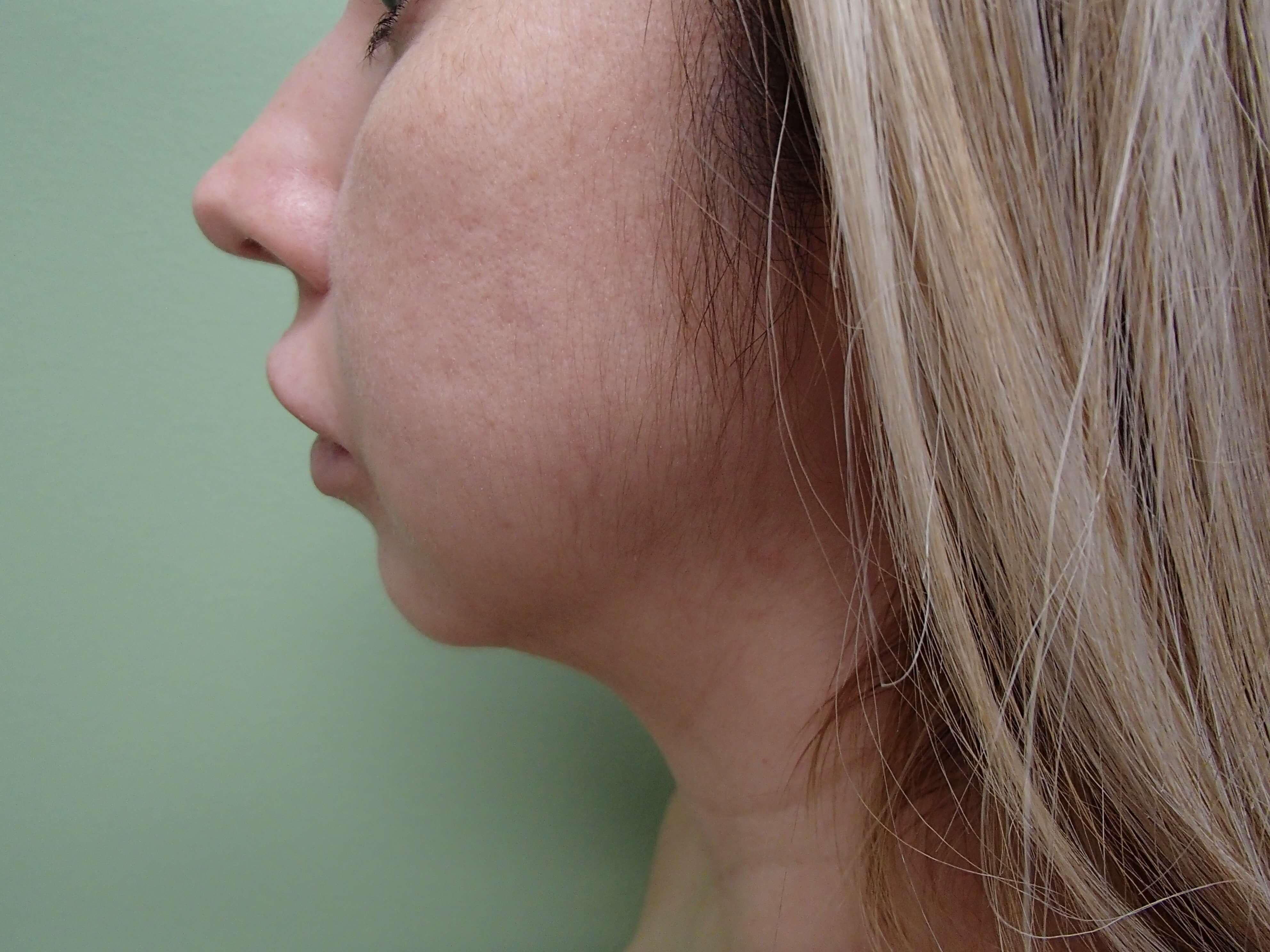 Neck Lipo w/ Chin Augmentation Before